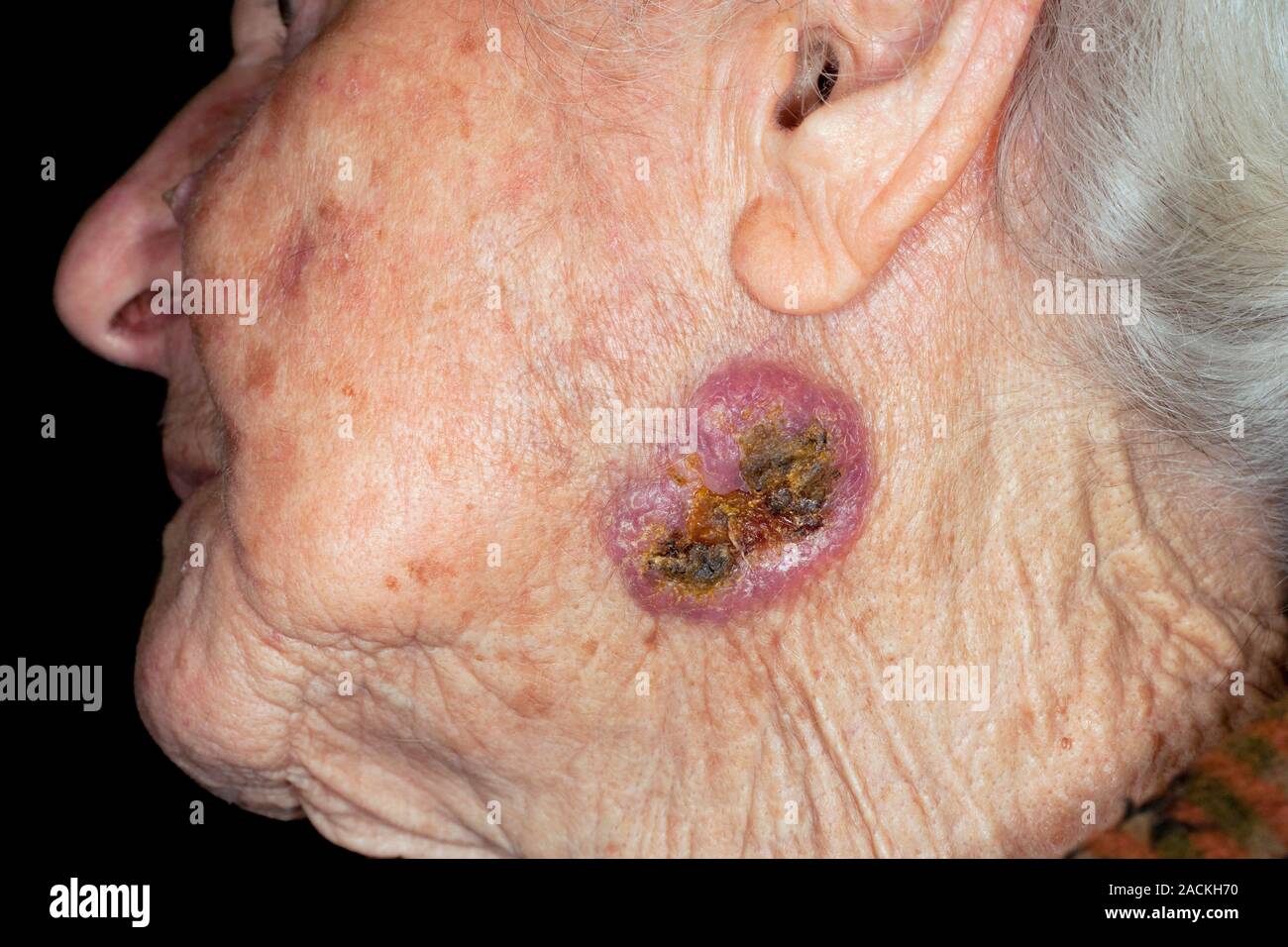 Basal cell carcinoma (skin cancer) on the cheek of the face in an 84