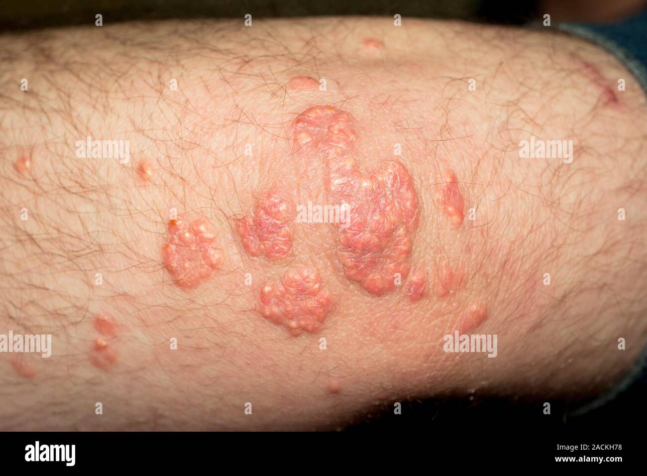Xantom Close-up of yellow papules (xanthoma) in the skin of the elbow in an ...