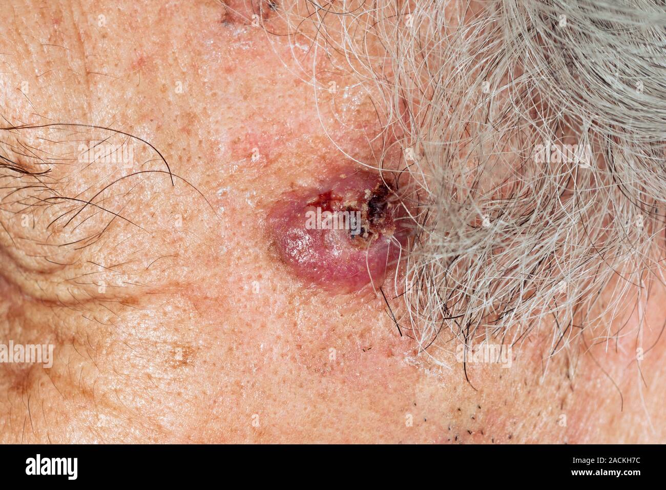 Closeup of a basal cell carcinoma (skin cancer) on the temple of the
