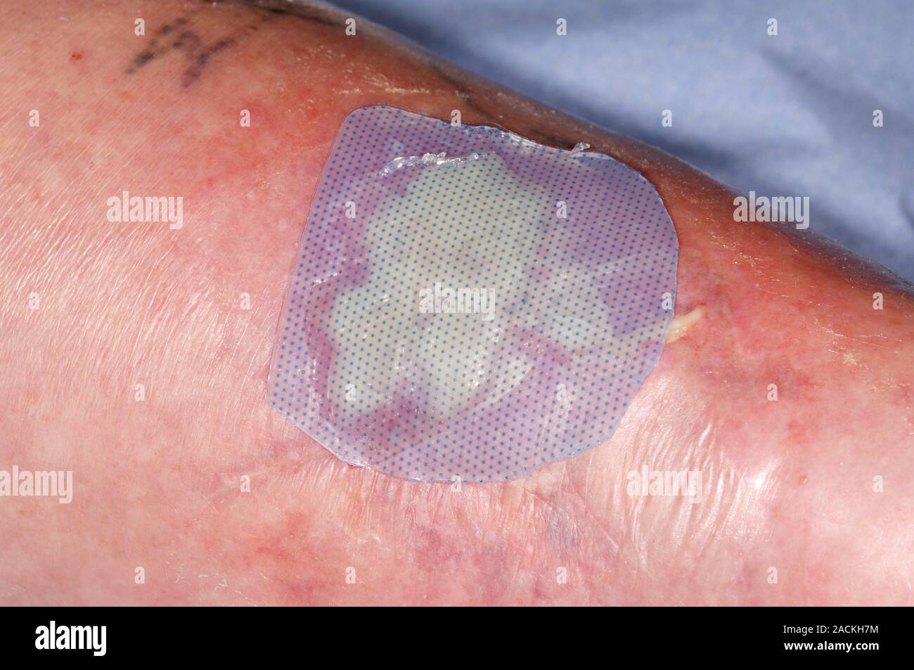 Closeup of an blister treated with actifoamCool dressing on the calf