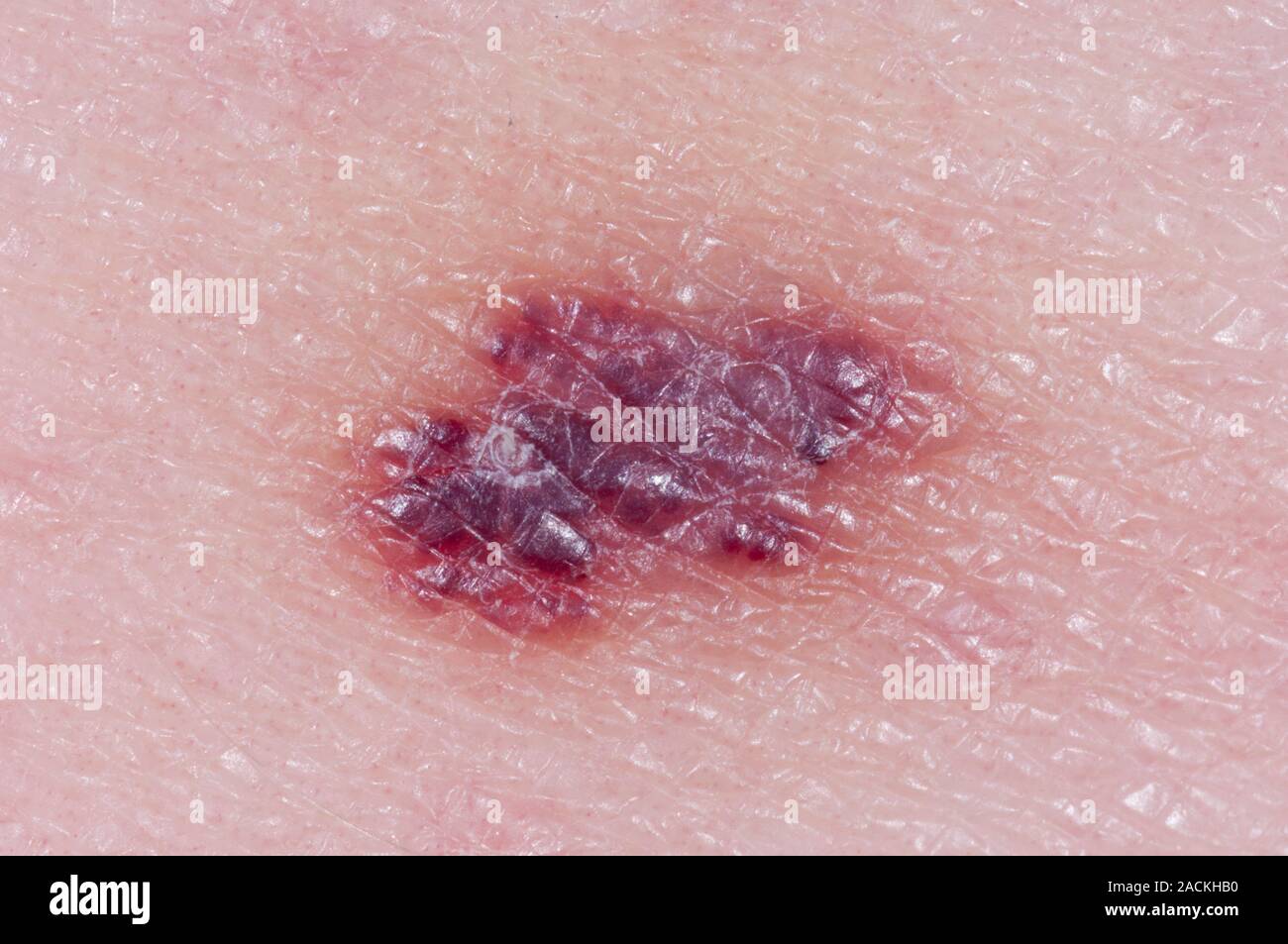 Closeup of a pigmented haemangioma on the skin in a 46 year old female