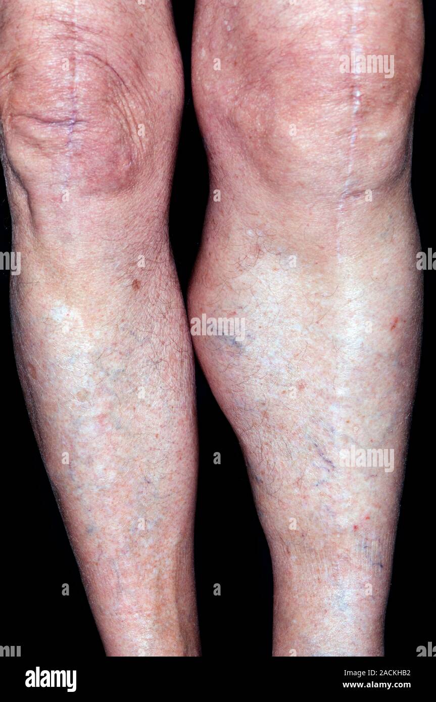 Large lump below the knee of the leg in a 78 year old male patient