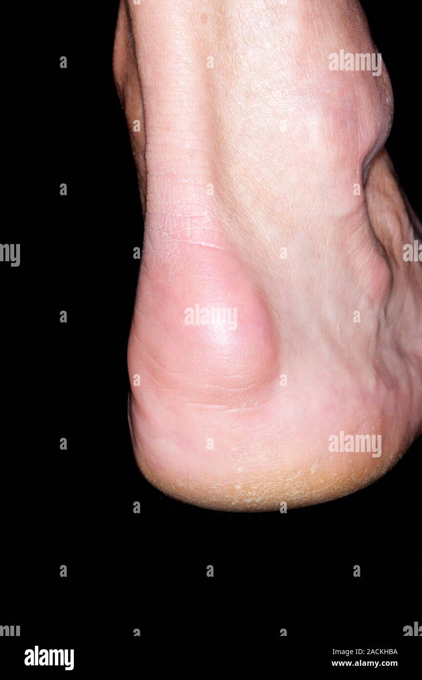 Red and swollen heel (calcaneal) joint of the foot in a 66 year old
