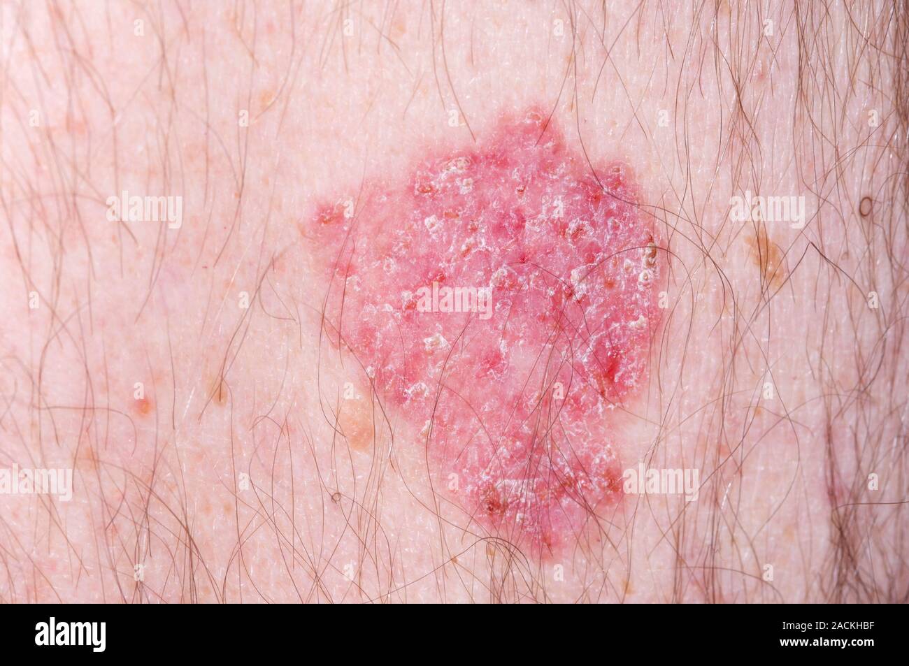Close Up Of A Basal Cell Carcinoma Skin Cancer That Is Superficial