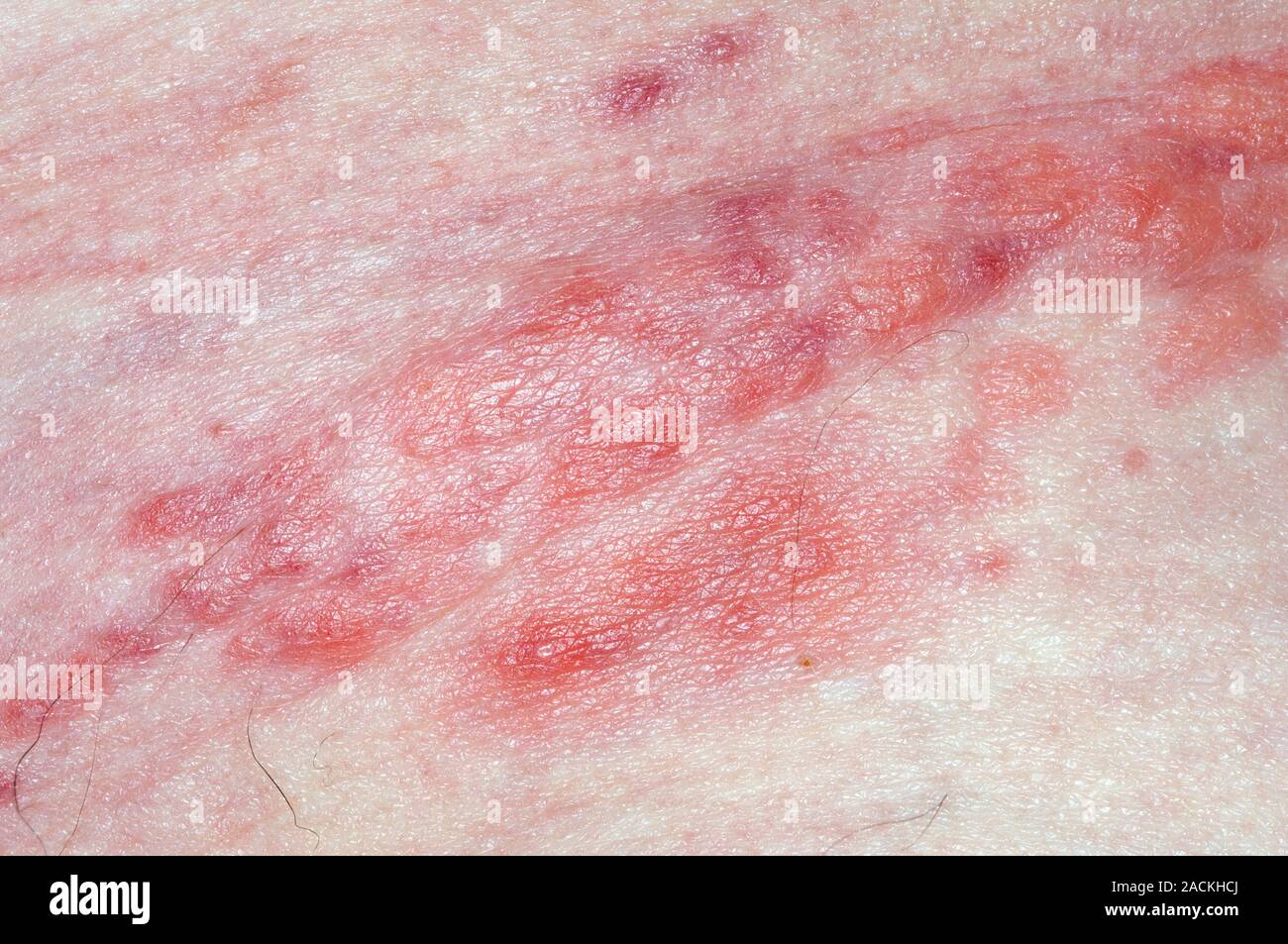 Closeup of a shingles rash of blisters on the skin in a 65 year old