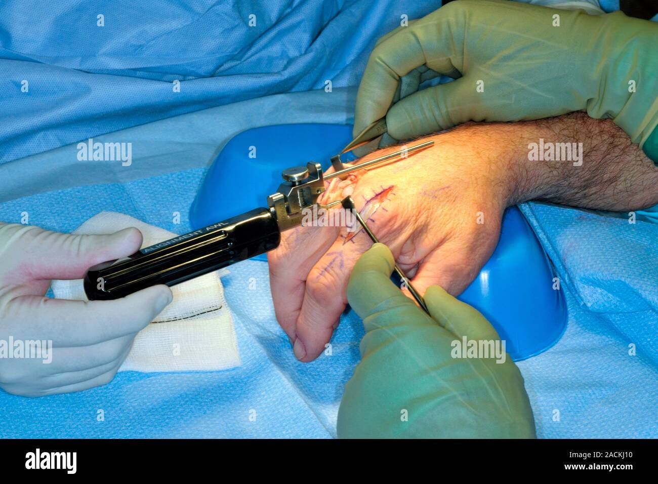 Knuckle joint replacement surgery. Orthopaedic surgeons carrying out a