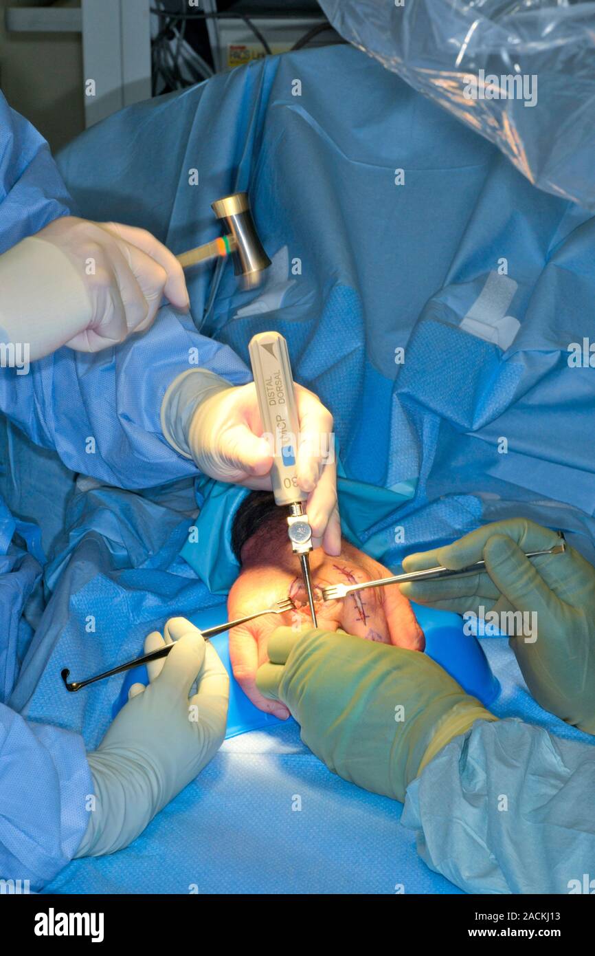 Knuckle joint replacement surgery. Orthopaedic surgeons carrying out a