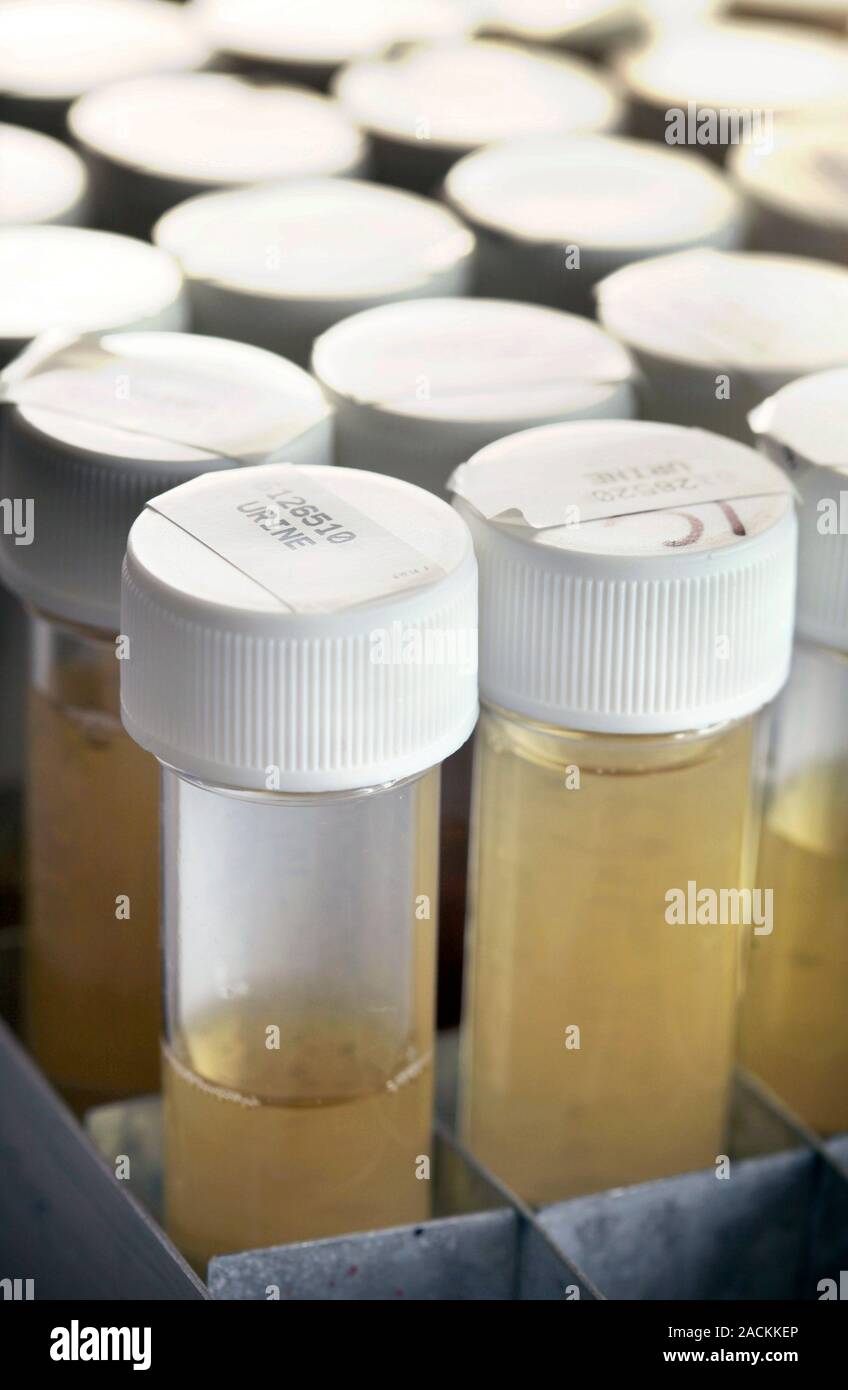 Samples of urine are stacked in trays before being tested for bacterial