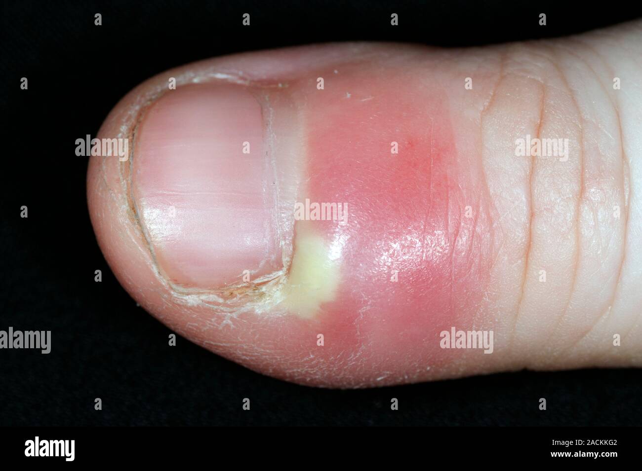 Close-up of pus under the skin from an infection around the fingernail in a 22 year old female patient. This skin inflammation and infection, usually Stock Photo
