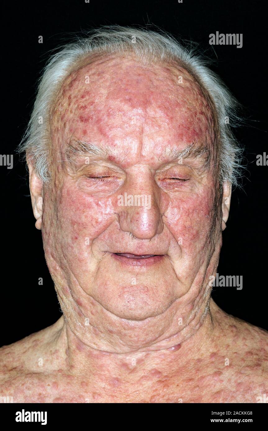 Acute eczema on the face and neck in a 79 year old male patient after