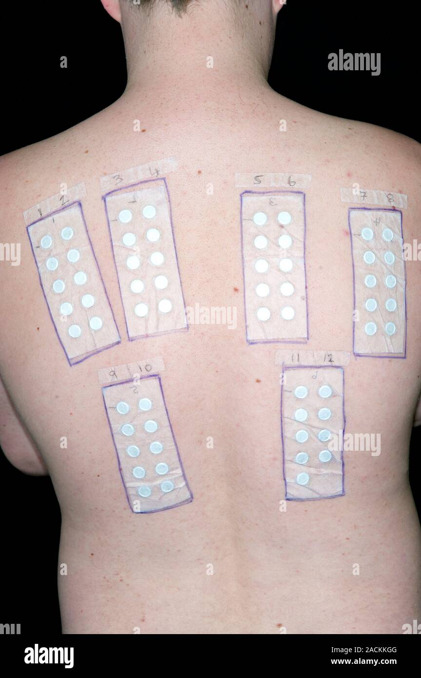 Six allergy test strips on the back of an 18 year old male patient to