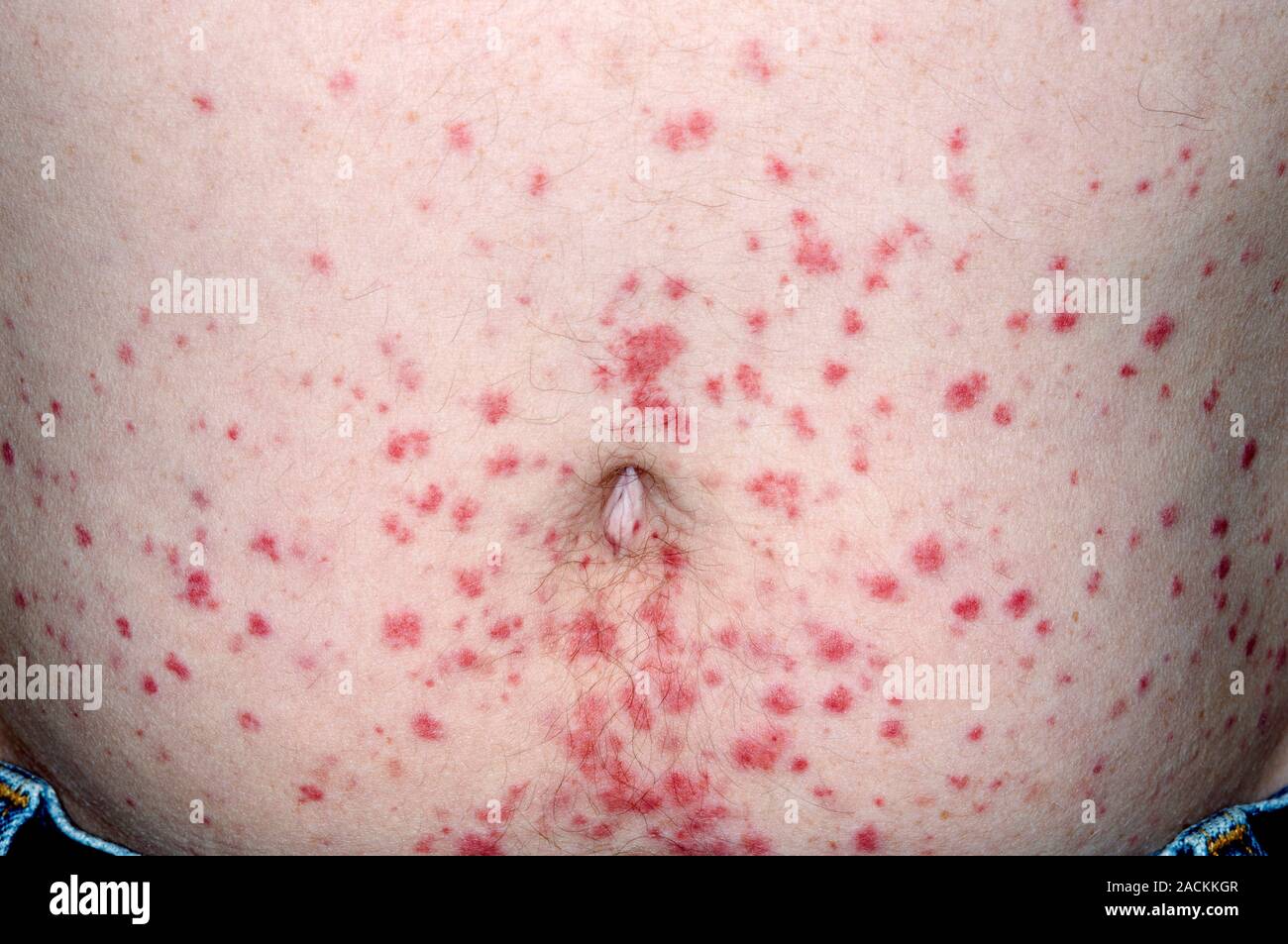 Purple Pressure Rash Purple rash (purpura) on the skin of the abdomen in a 45 year old male ...