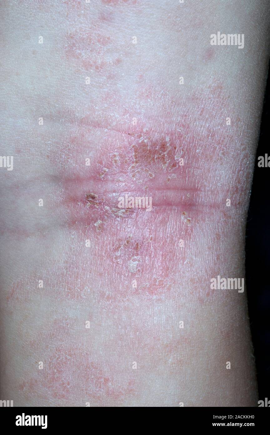 Closeup of atopic eczema on the back of the knee in a 2 year old