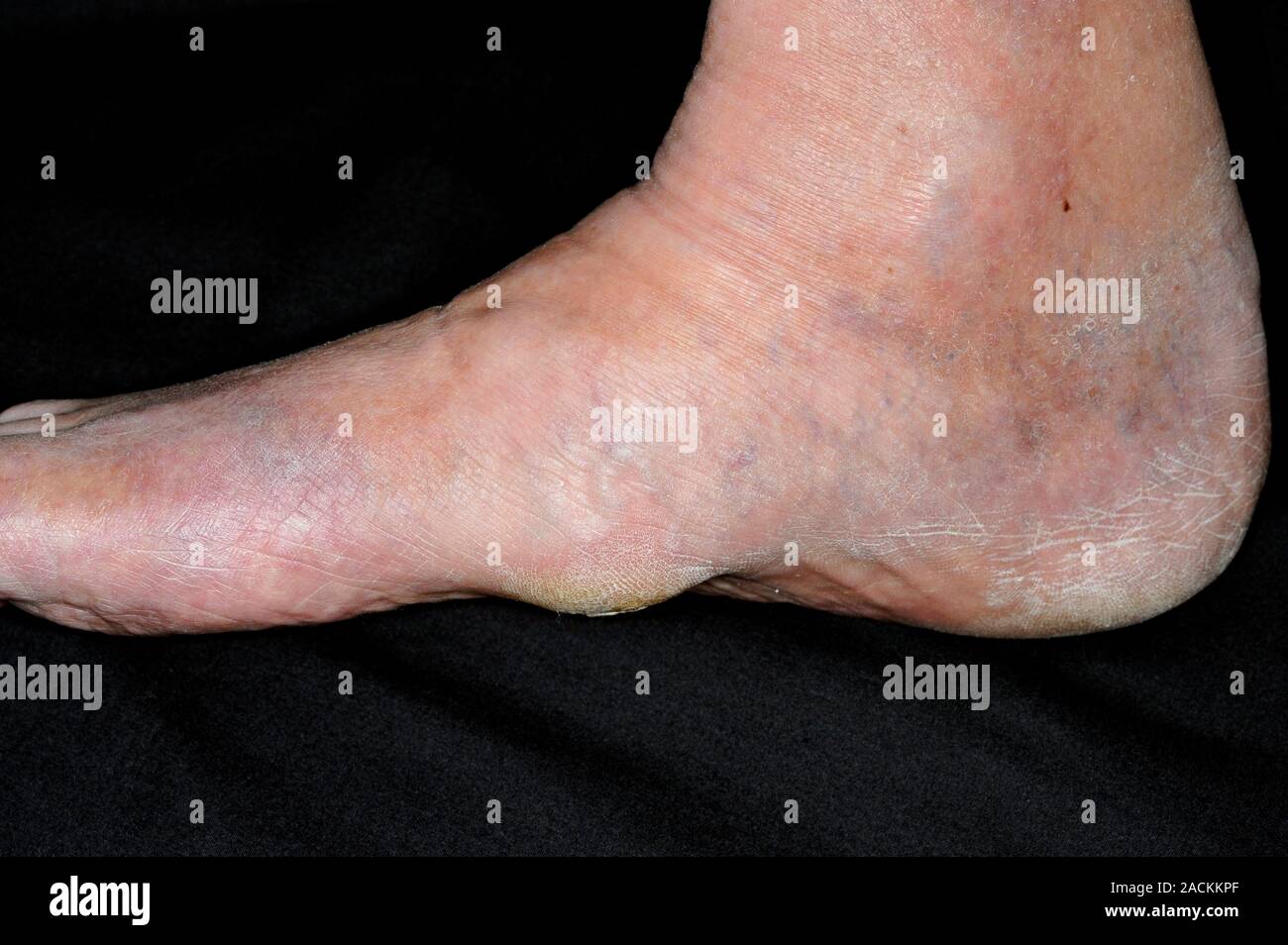Swelling in the foot due to degenerative changes at the tarso