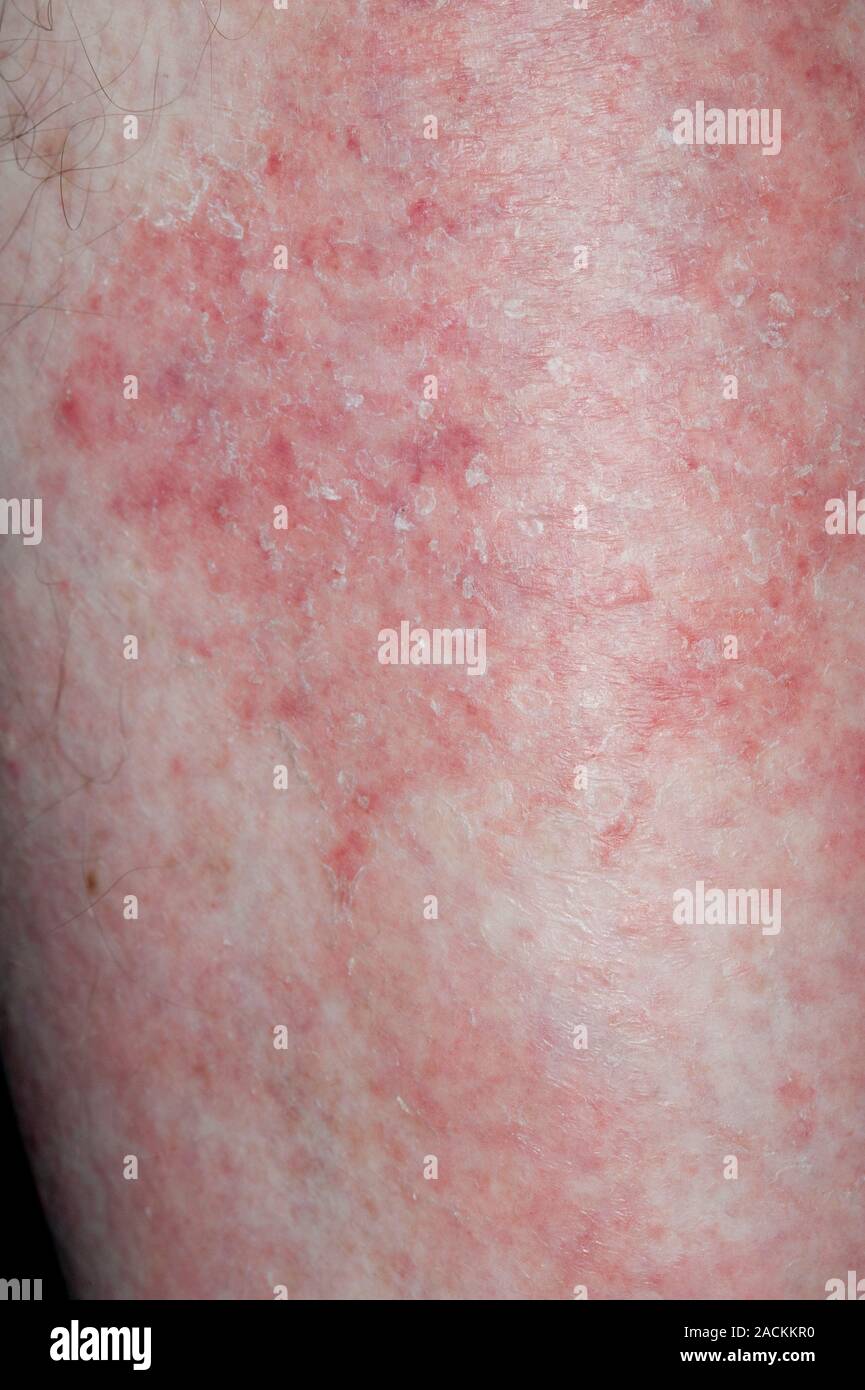 Close-up of red patches on the skin of the leg in a 66 year old male ...