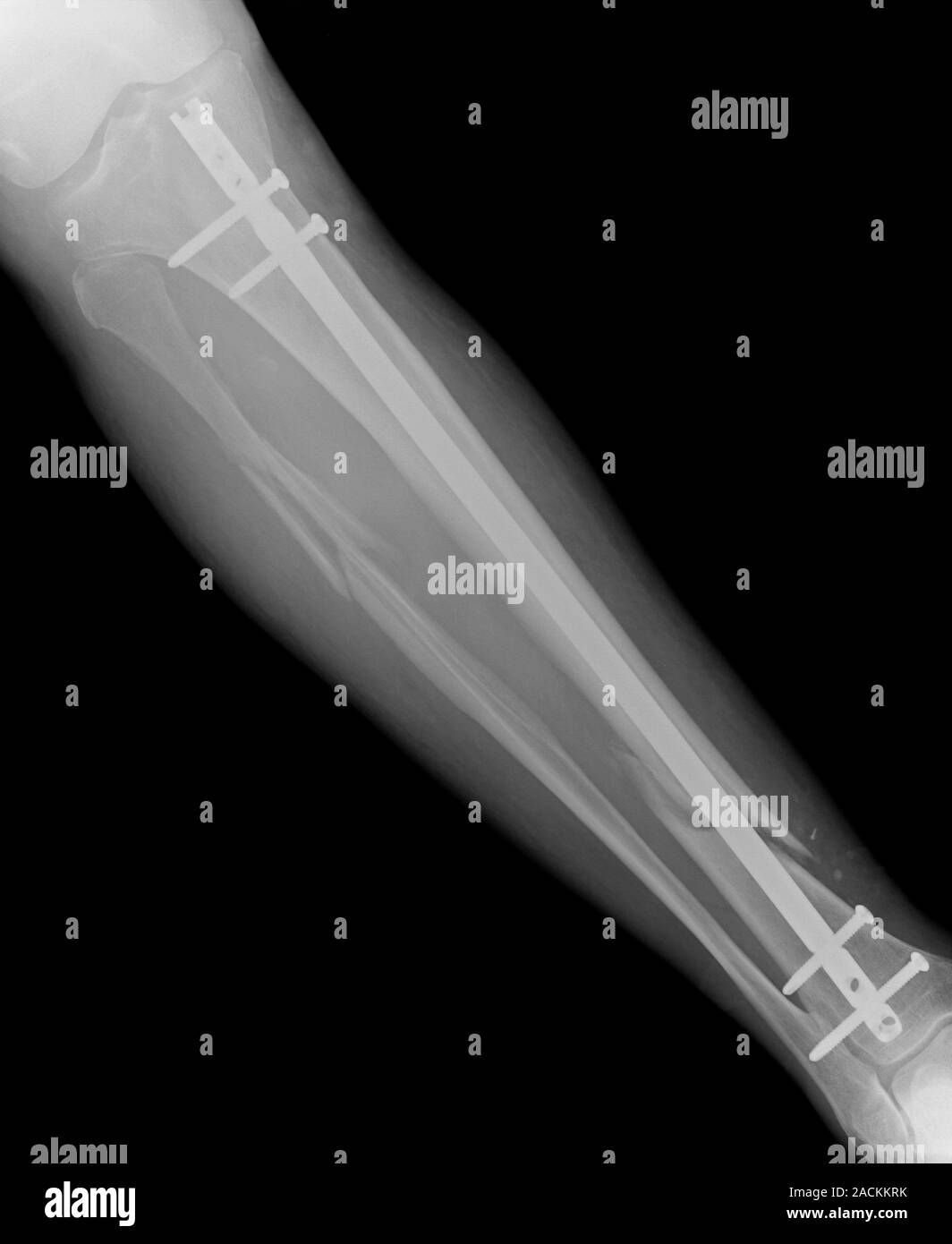 X-ray after surgery of the fractured tibia and fibula bones of the leg ...