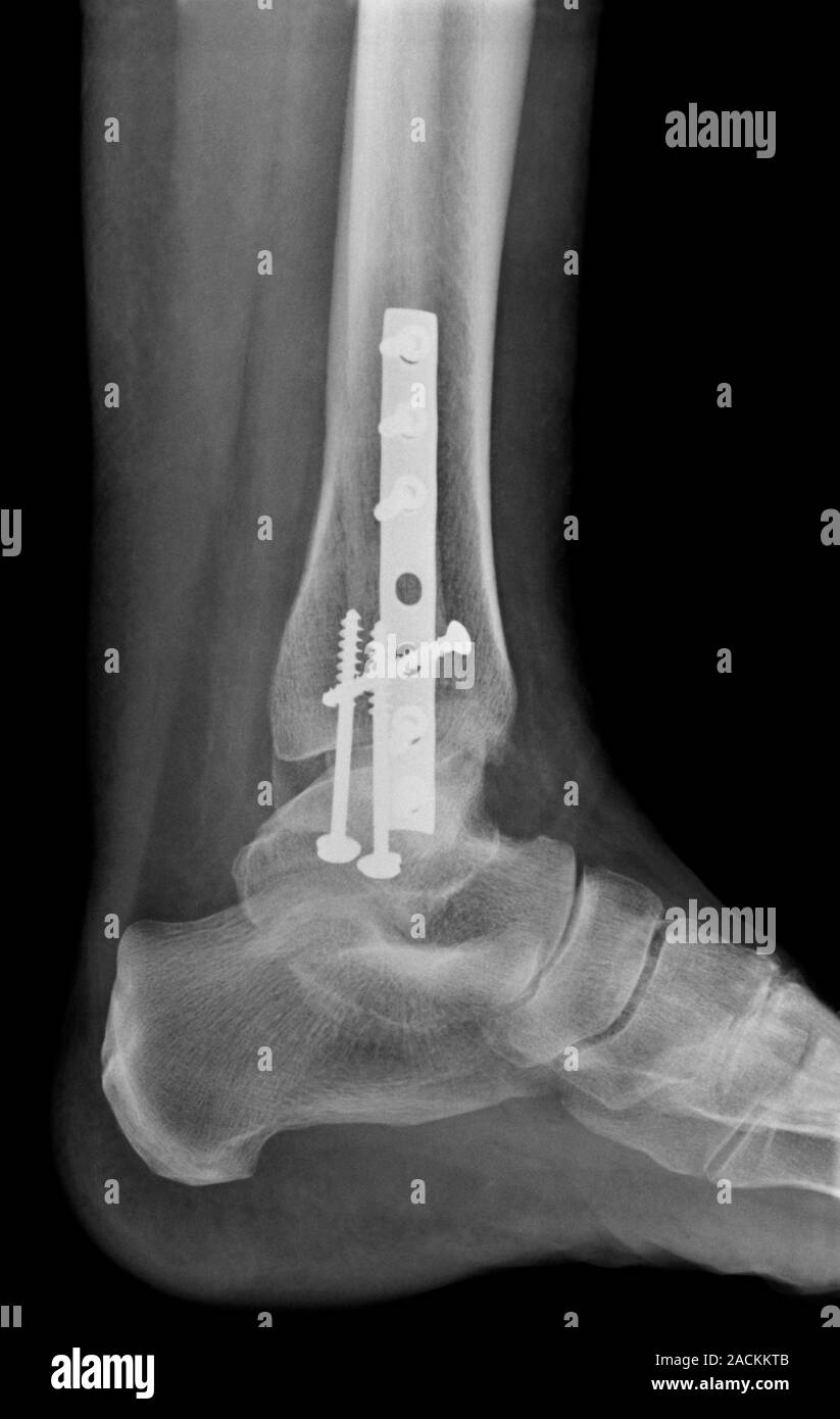 X-ray (side view) of the broken ankle (tibia and fibula leg bones) in a ...