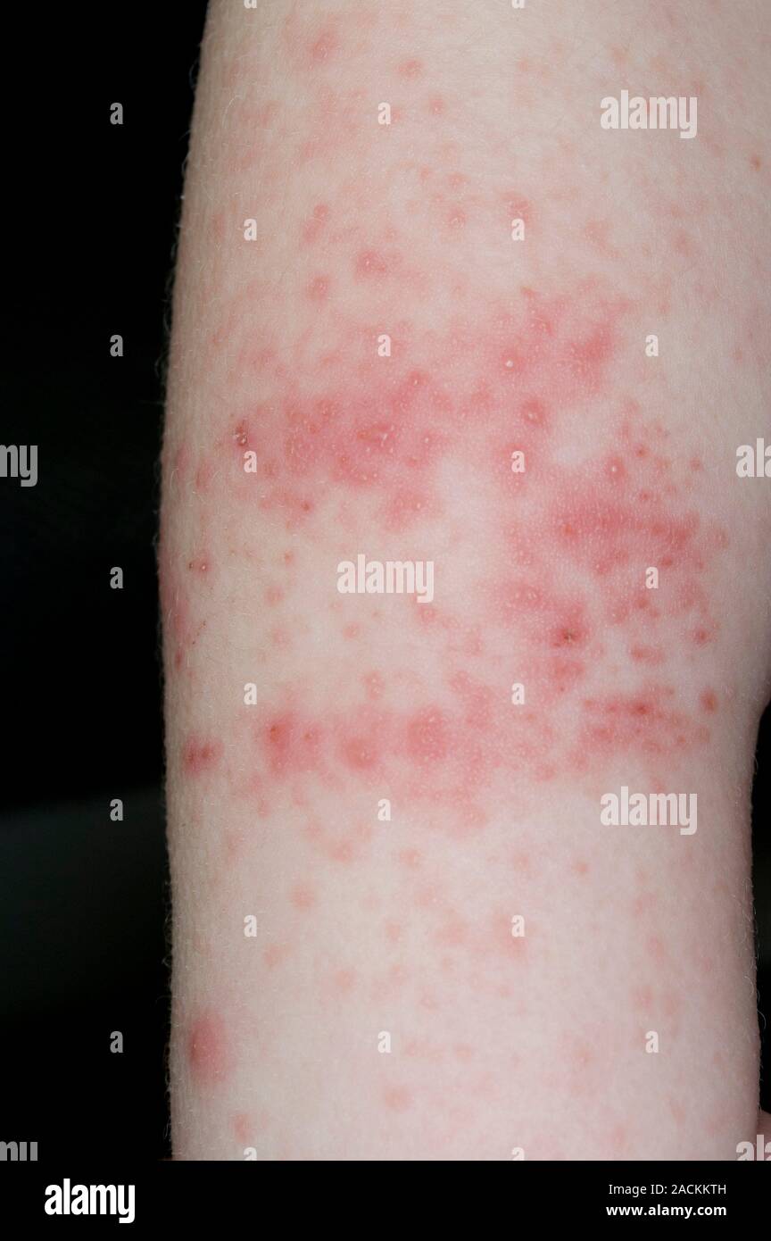 Lesions forming a skin rash on the arm in a two year old male patient ...