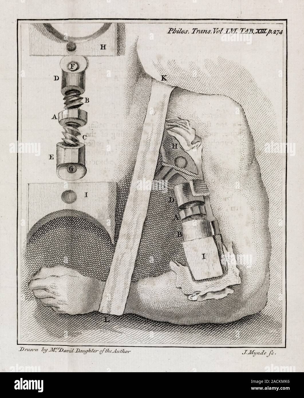 Bone-setting mechanism. 18th-century journal page illustrating a ...