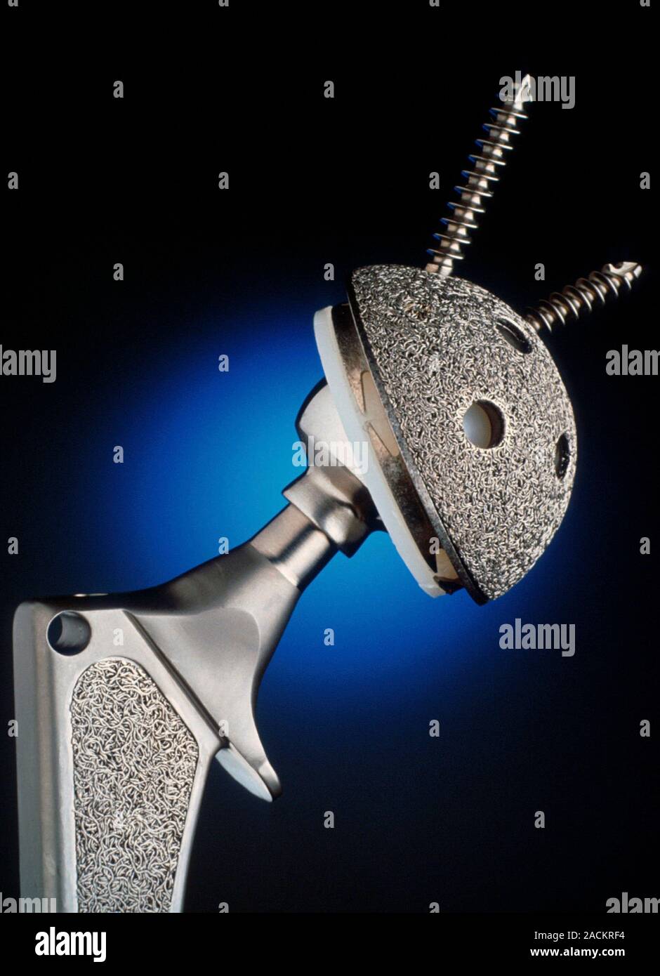 Prosthetic hip joint. This artificial hip joint is made from titanium