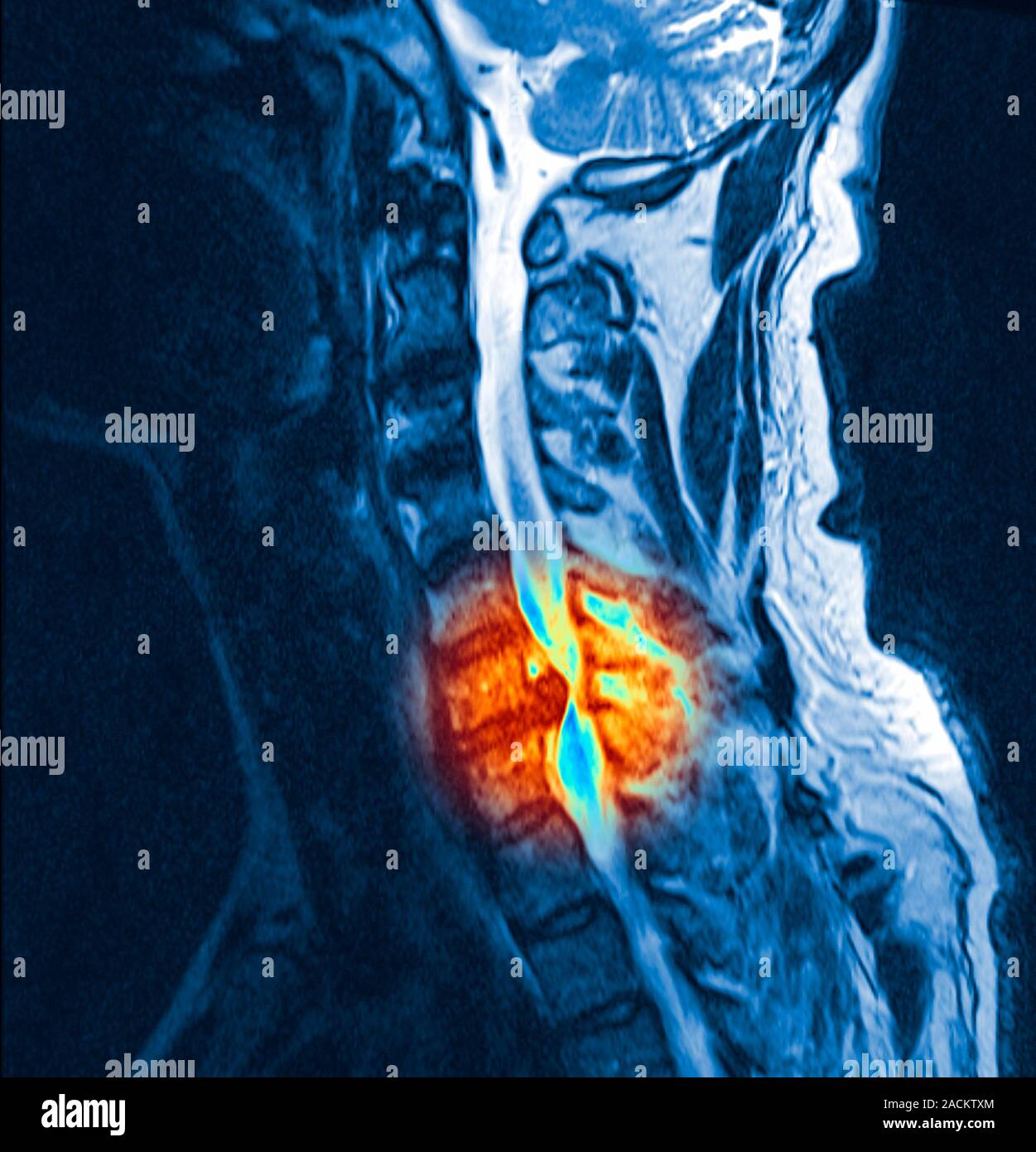 Slipped disc, coloured resonance imaging (MRI) scan. Profile