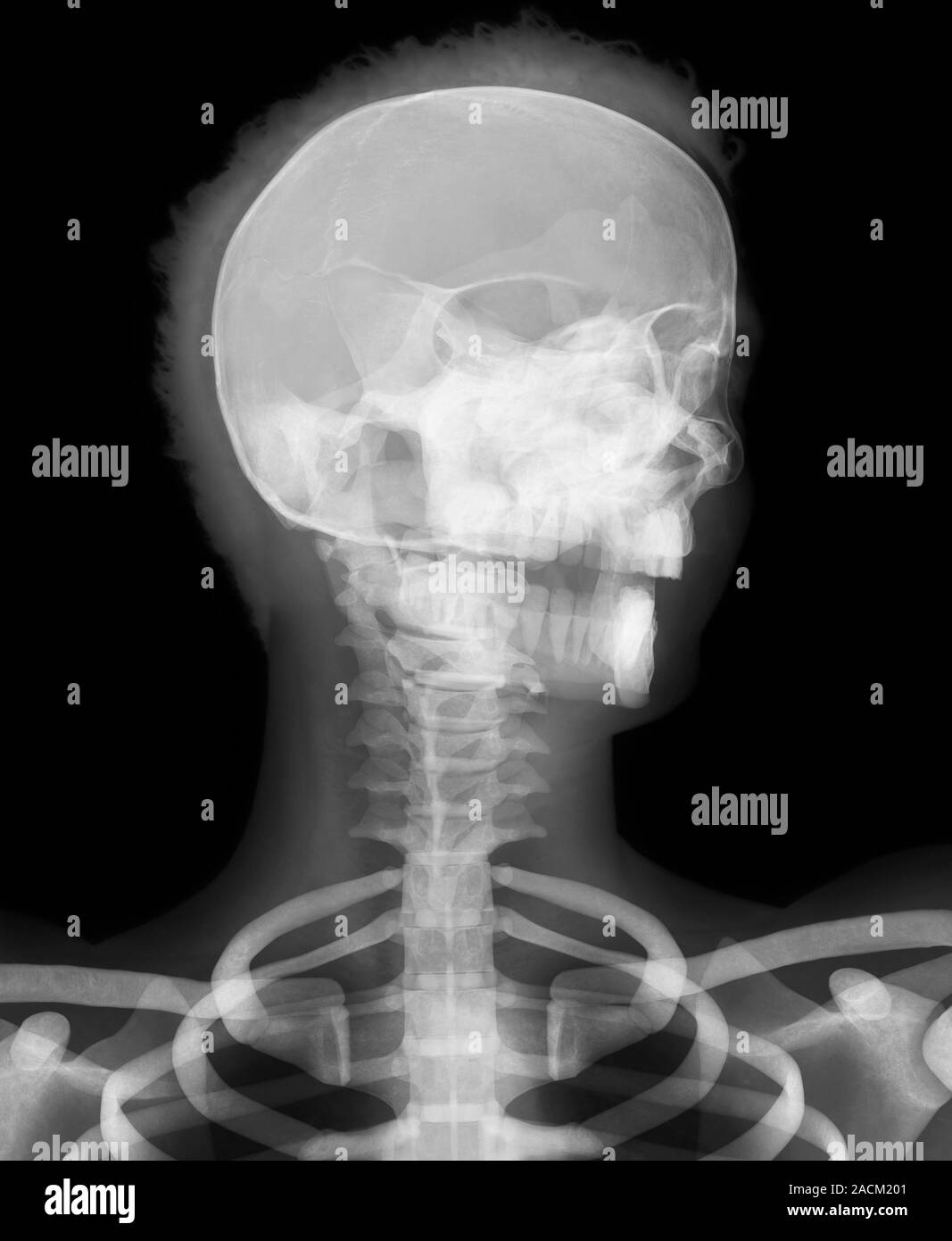Human head, Xray. This man's head is turned to his lefthand side (to