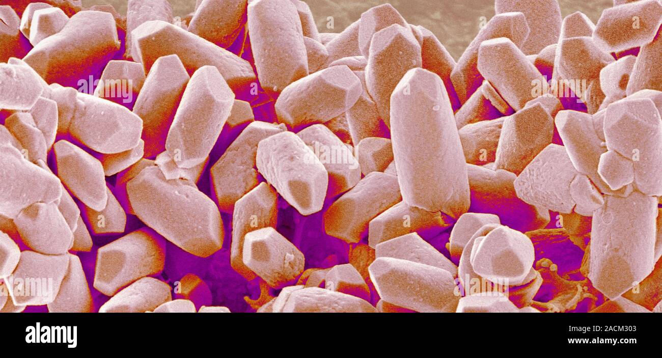 Balancing stone from inner ear. Coloured scanning electron micrograph