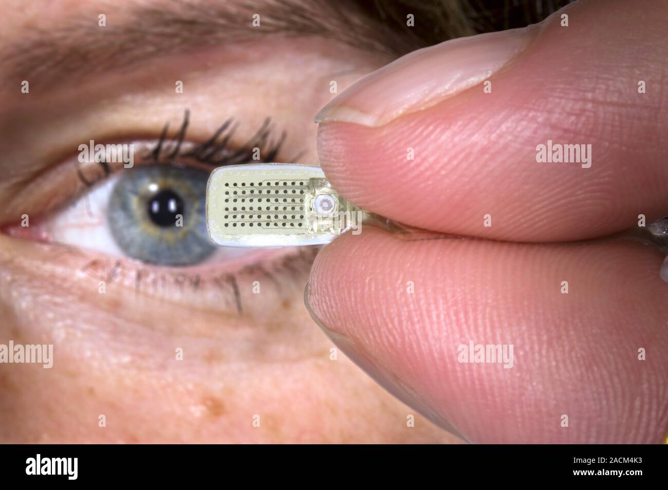 Argus II artificial retina. Researcher holding an Argus II retinal