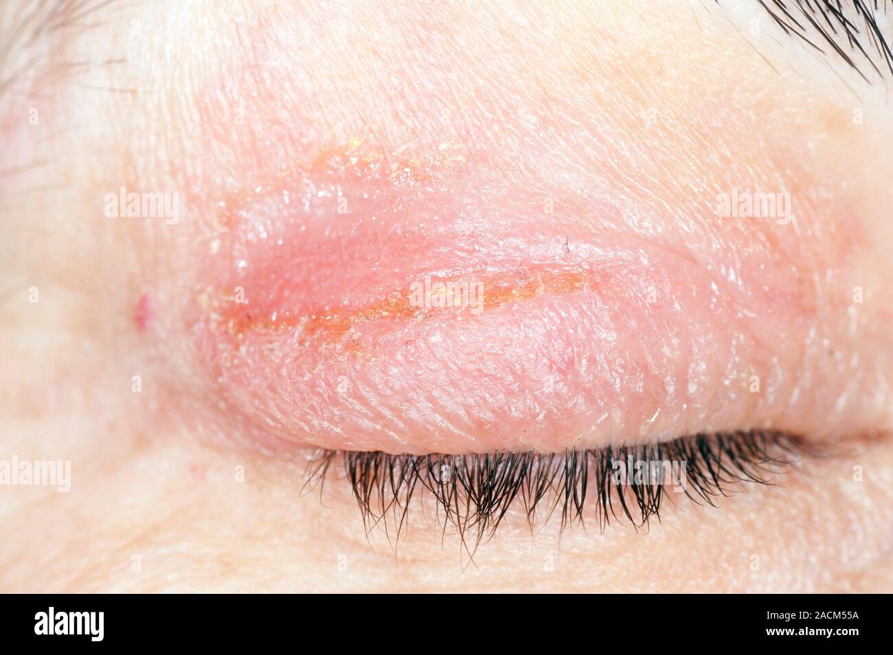 Closeup of infected eczema on the eyelid in a 46 year old female