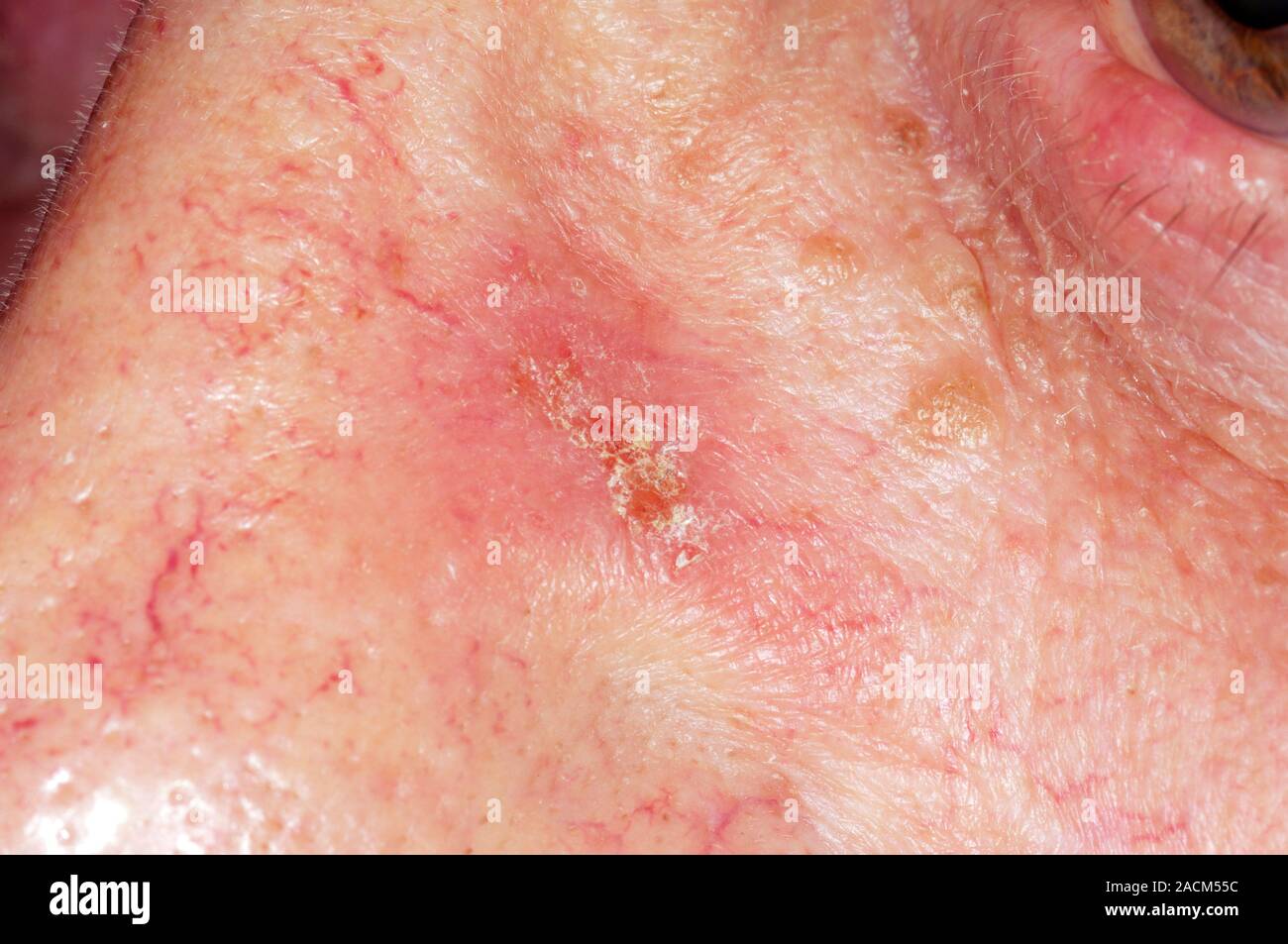 Reddening of the skin on the nose in a 63 year old male patient, an allergic skin reaction to