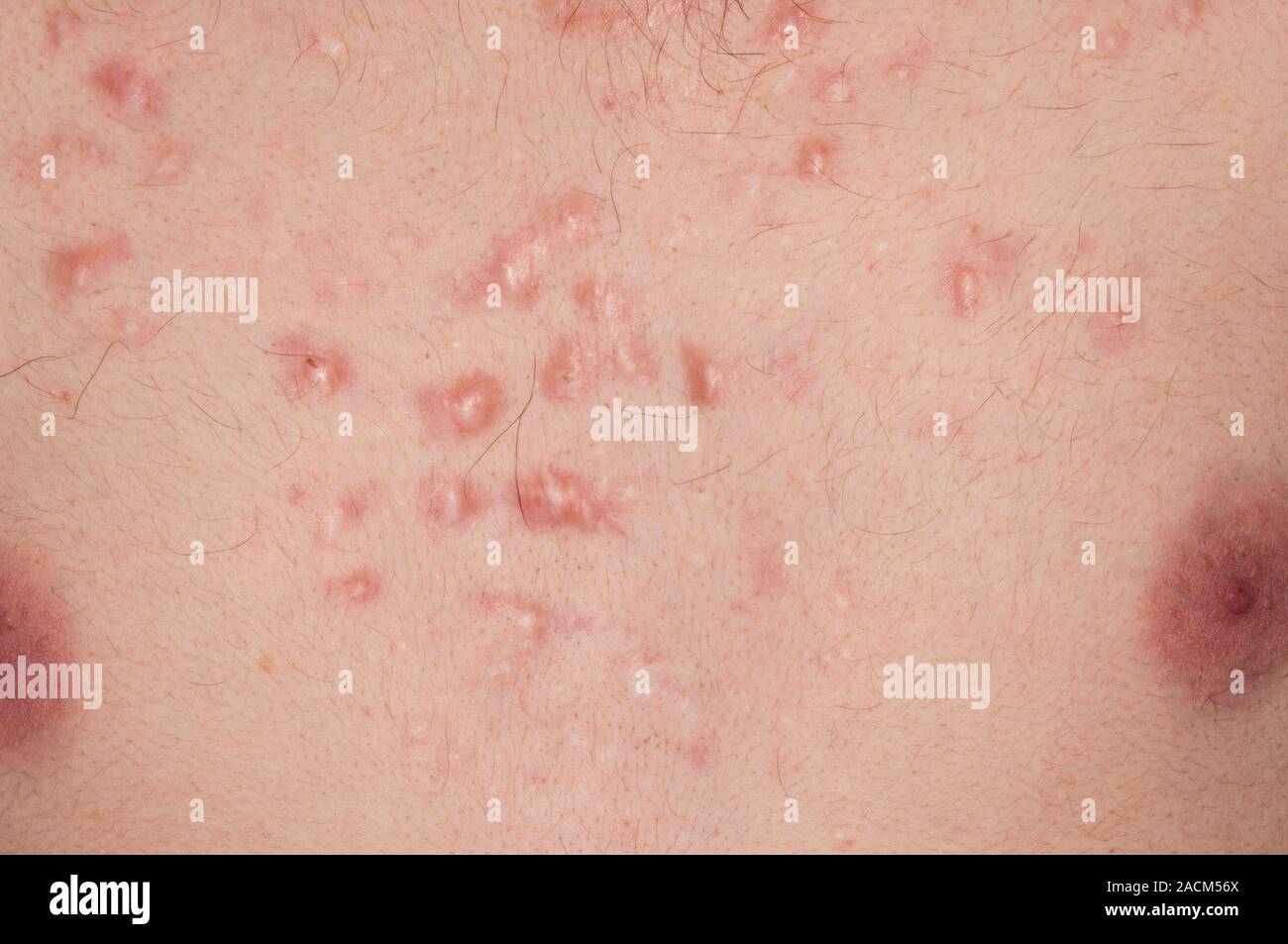 Keloid scarring from acne vulgaris on the chest in a 20 year old male