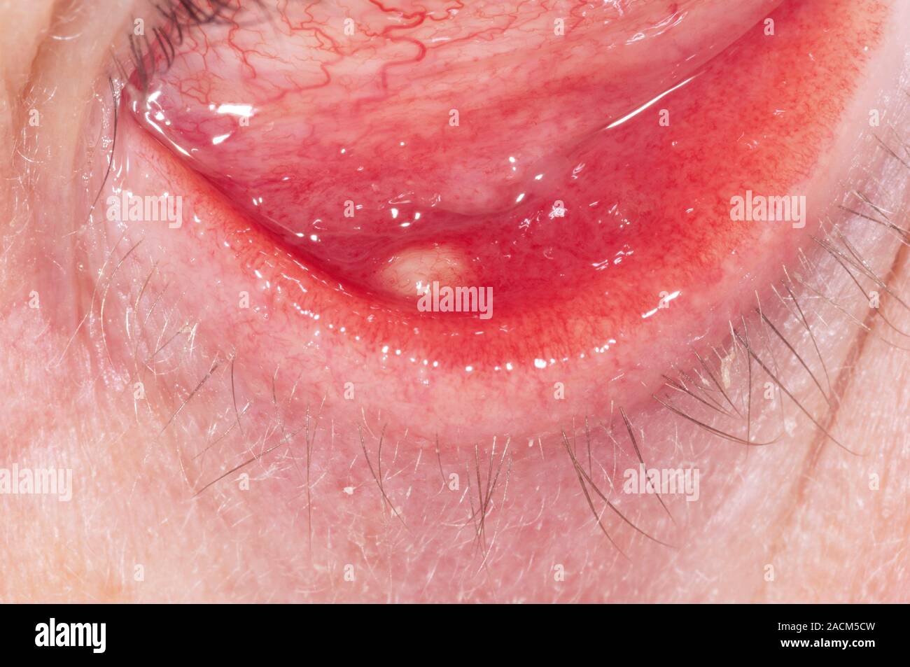 Cyst sale inside eyelid
