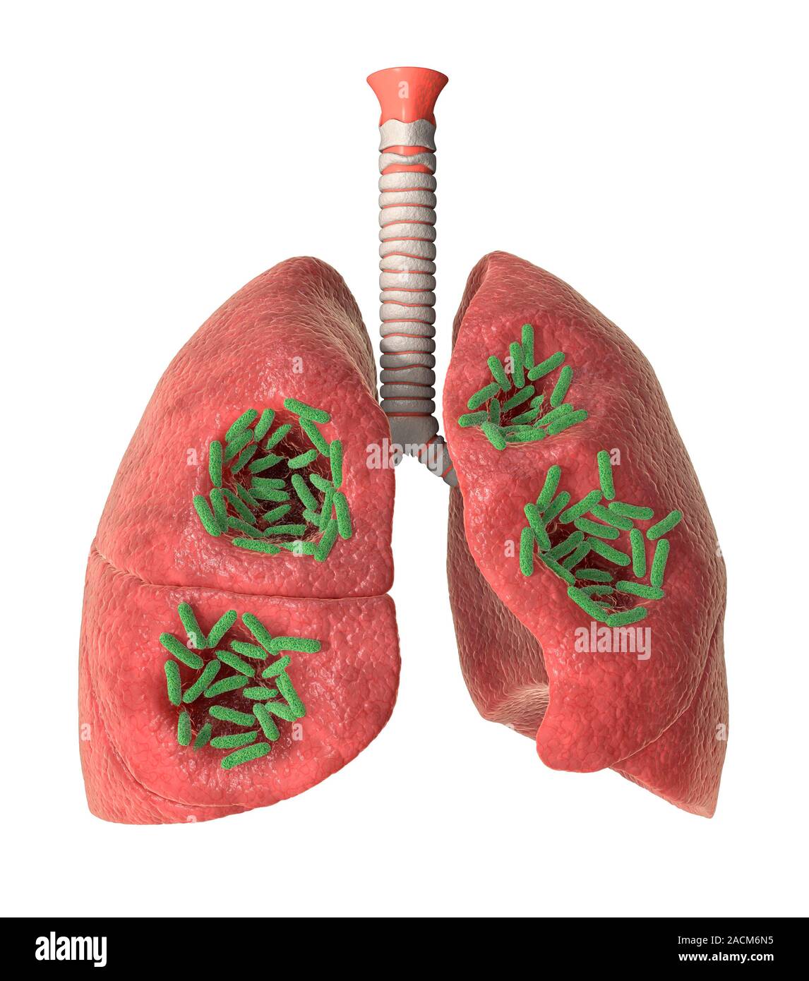 Bacterial lung infection. Computer artwork showing rodshaped bacteria