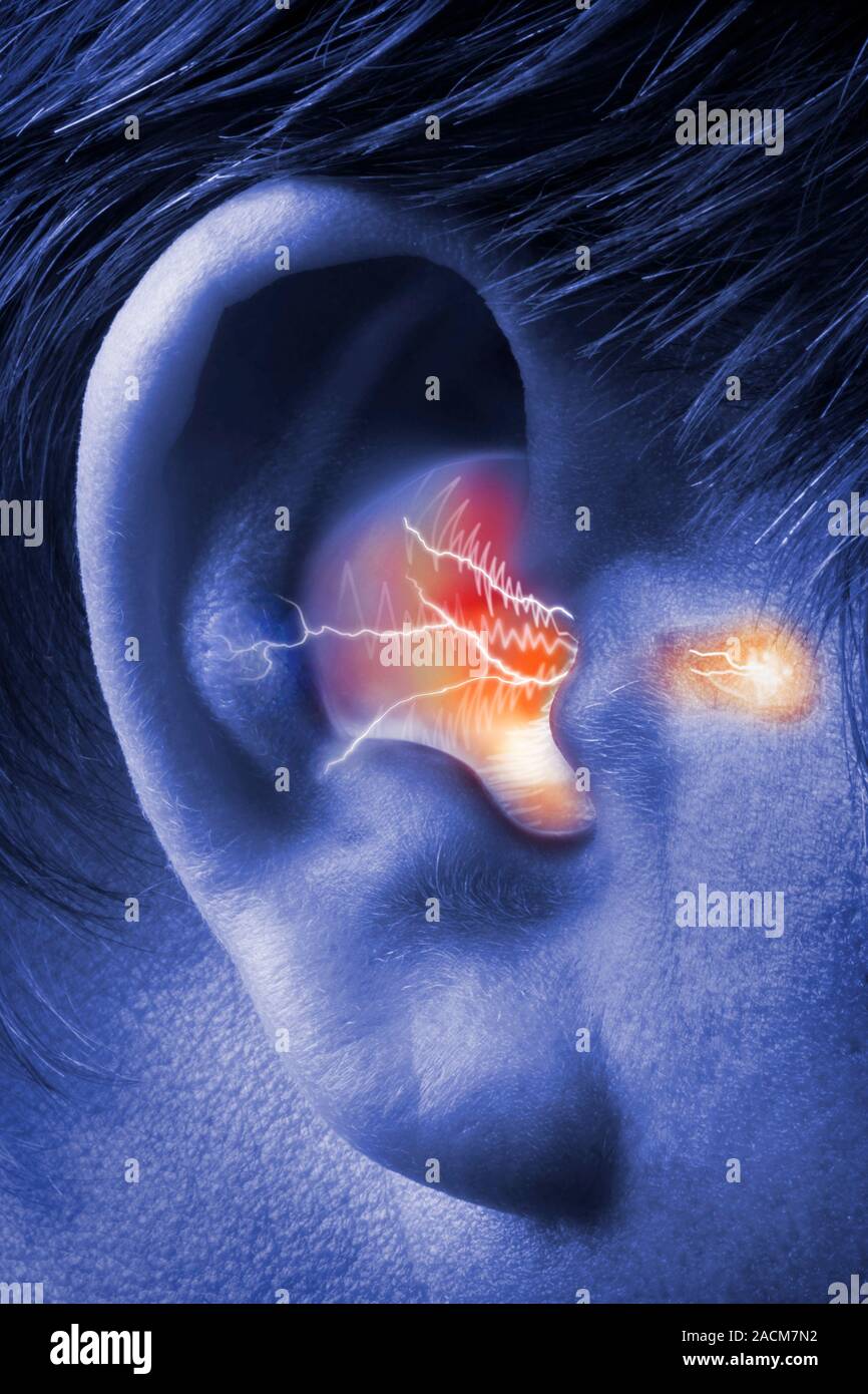 Tinnitus, conceptual image. Tinnitus is a ringing in the ears often caused as a symptom of ear