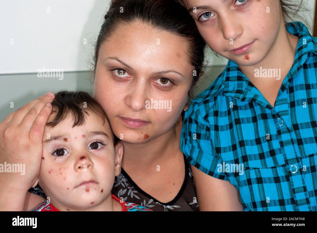 Family spread of impetigo, a bacterial skin infection, between a mother ...