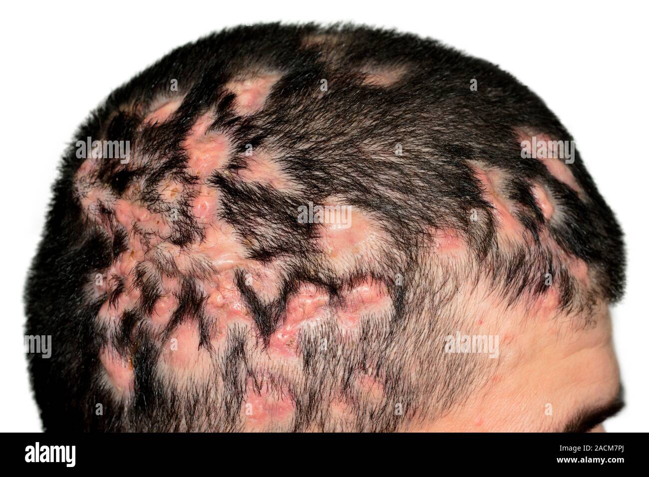 Inflamed skin nodules and hair loss (alopecia) on the scalp in an adult