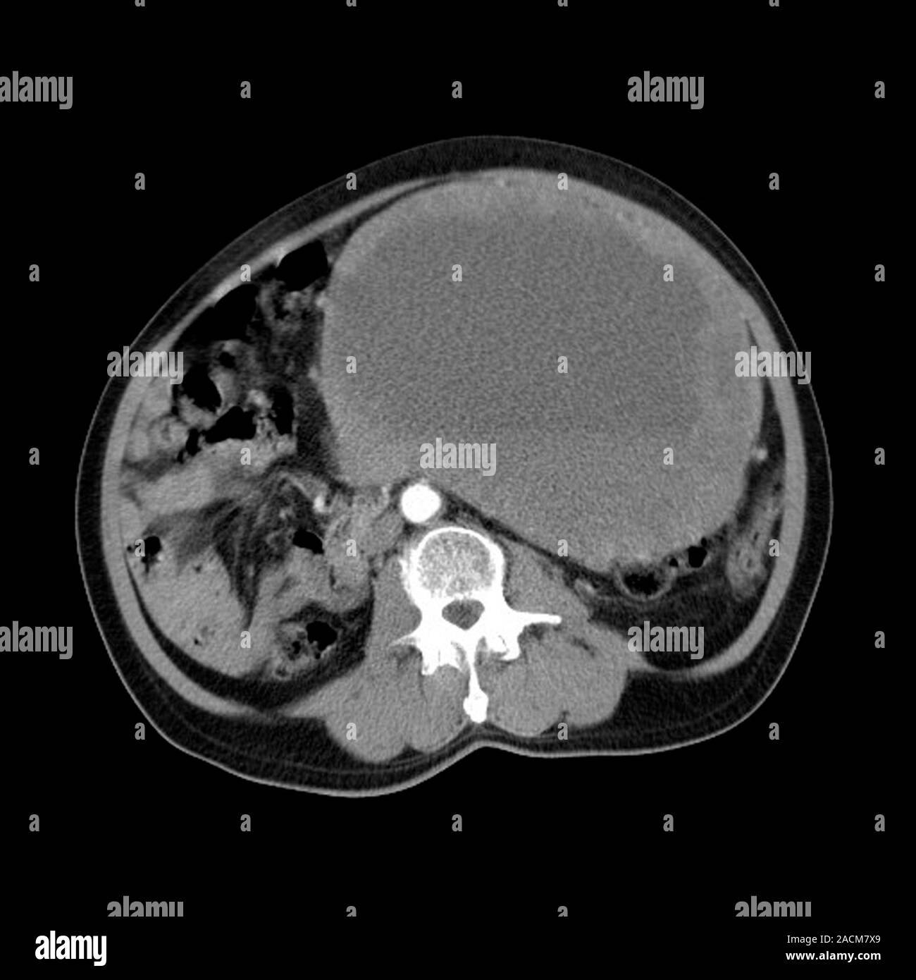 Abdominal sarcoma. Magnetic resonance imaging (MRI) scan of a malignant ...