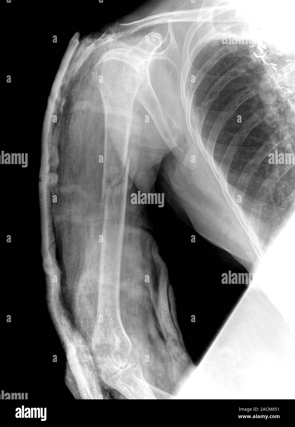 Chest Xray (front view) showing a fracture to the arm bone (humerus