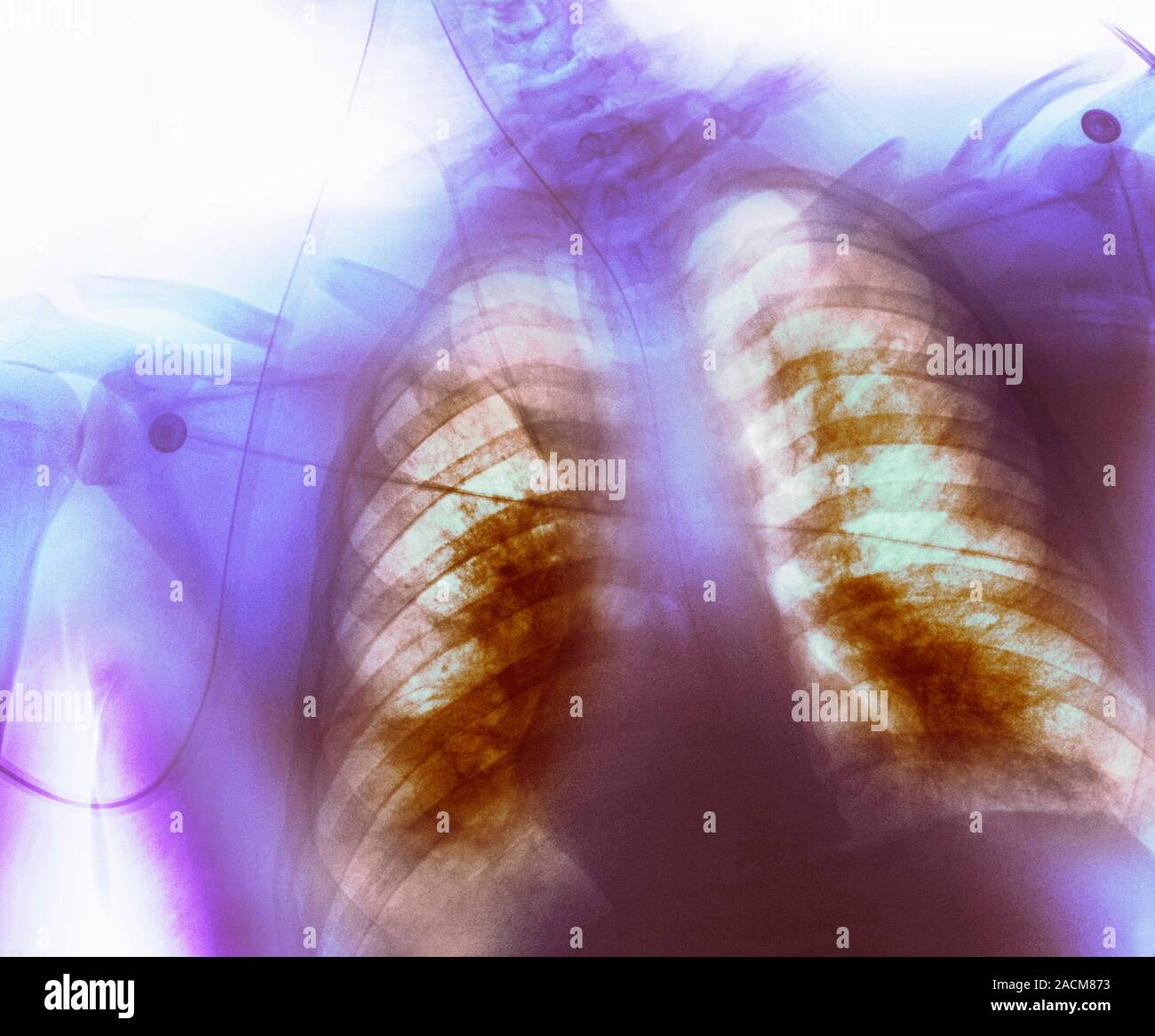 Coloured chest Xray (front view) showing widespread inflammation in