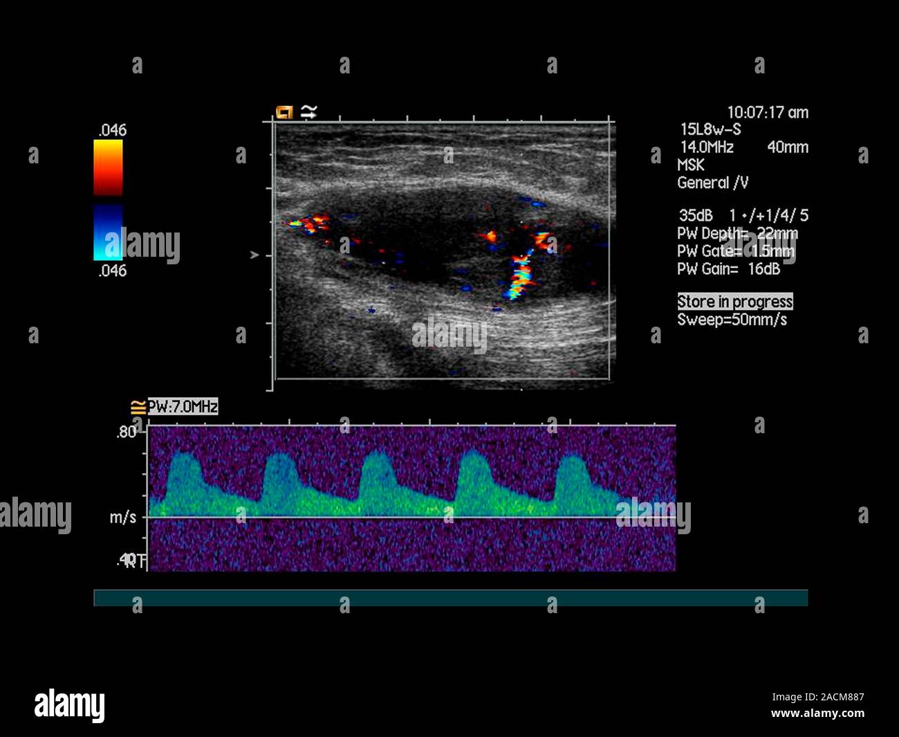 Buttock cancer. Doppler ultrasound scan of the buttock of a 45 year old woman showing increased