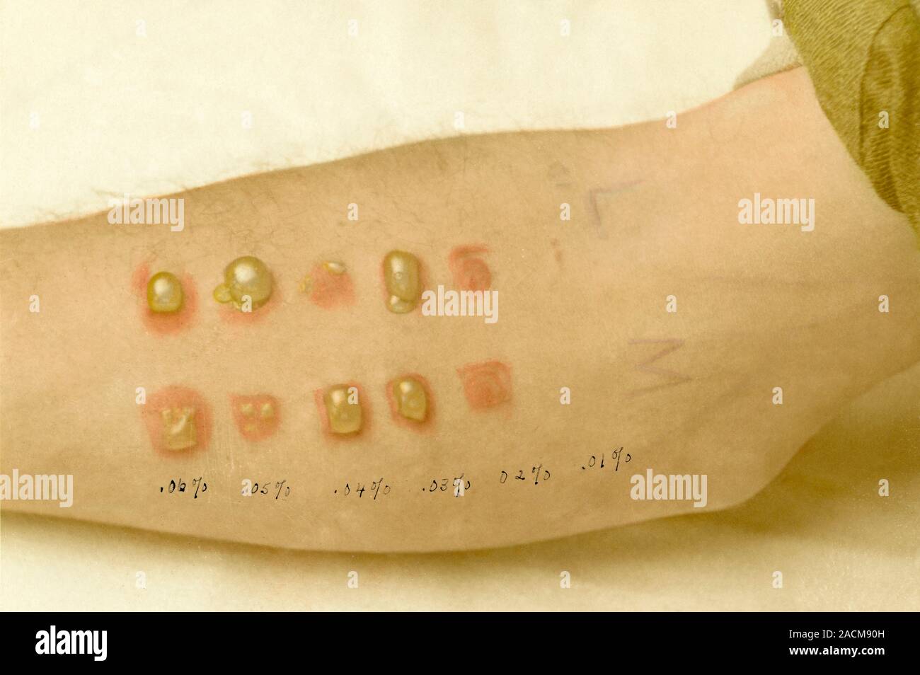 Mustard gas burns during testing. Arm of an American soldier at the end