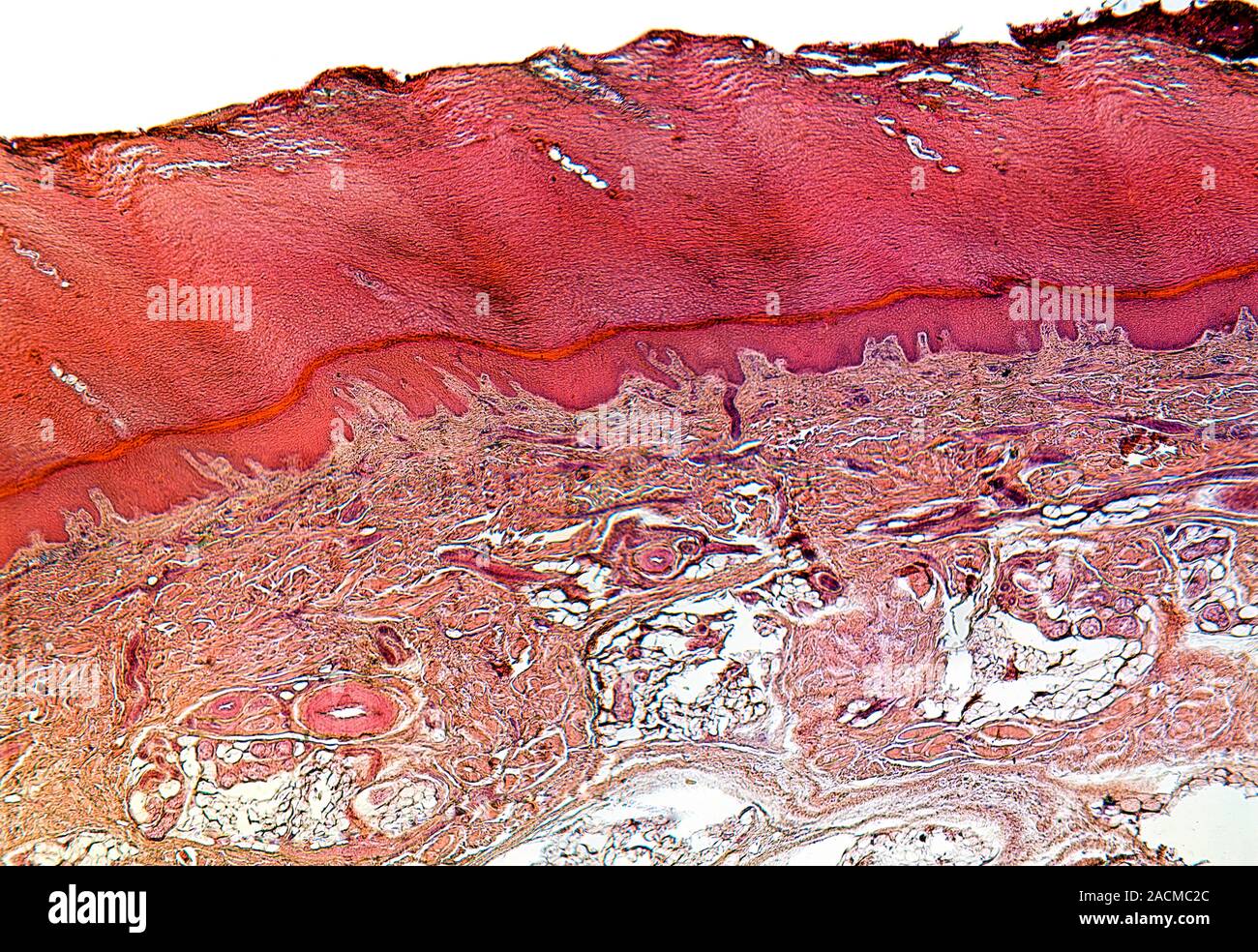 Sole of the foot. Light micrograph of a section through skin from the