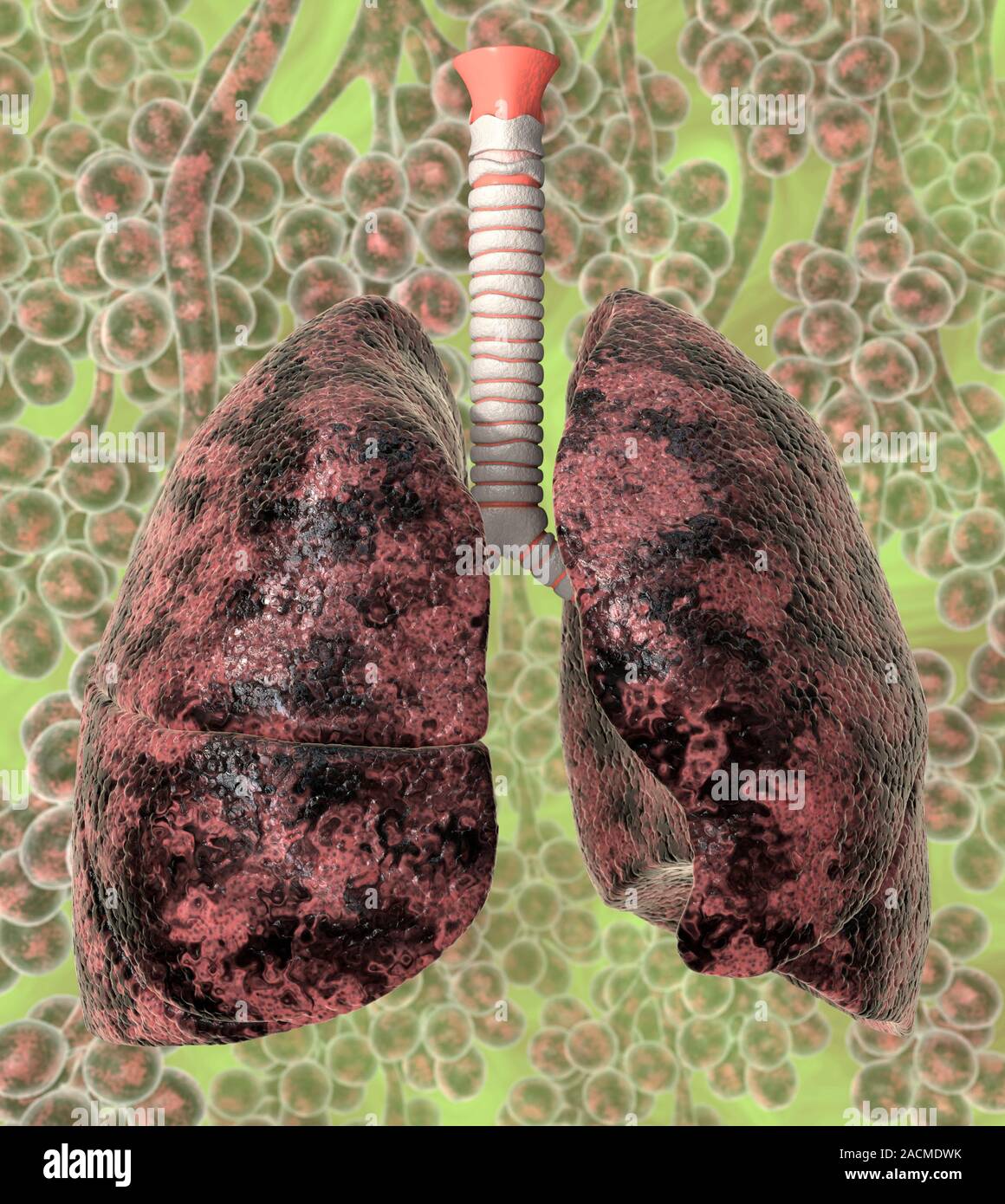 Smoker's lungs. Computer artwork of lungs damaged through smoking, with alveoli in the