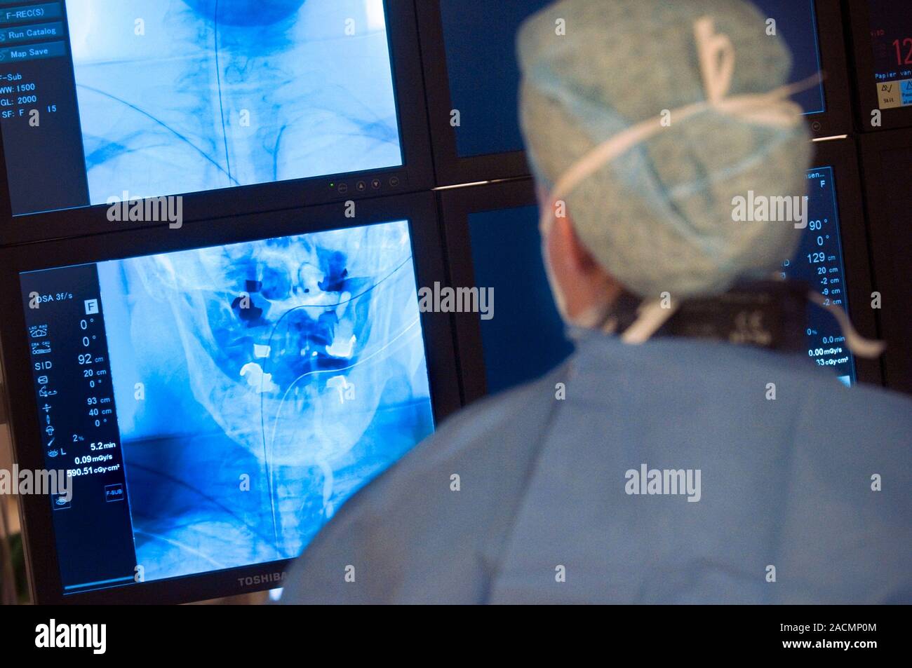 Vascular neurological intervention. Surgeon monitoring scans of a
