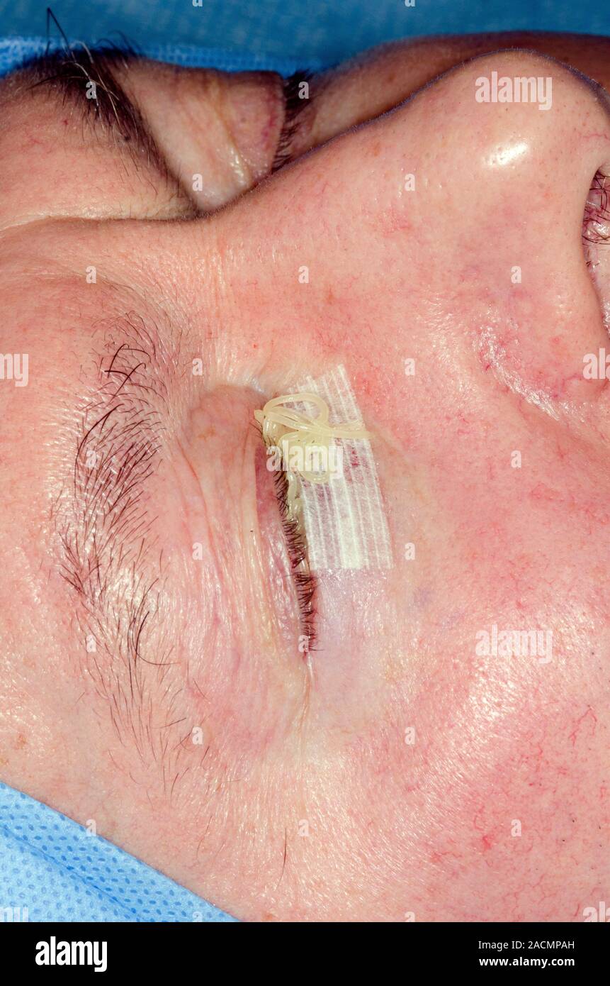 Dressed lower eyelid and antibiotic ointment applied into the eye of a 65 year old male patient