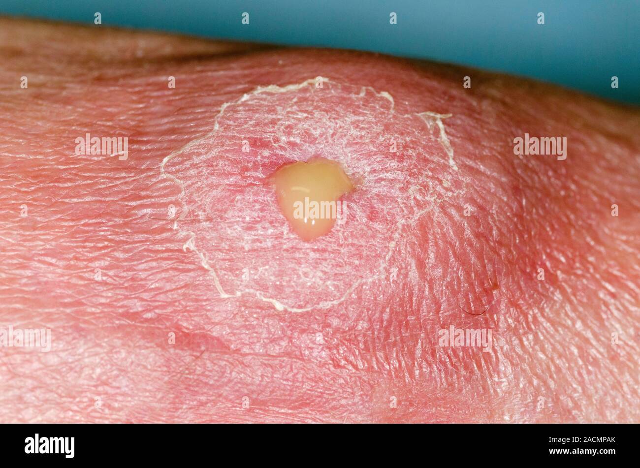 Close up Of A Red And Swollen Abscess with Pus Oozing On The Foot In close-up-of-a-red-and-swollen-abscess-with-pus-oozing-on-the-foot-in