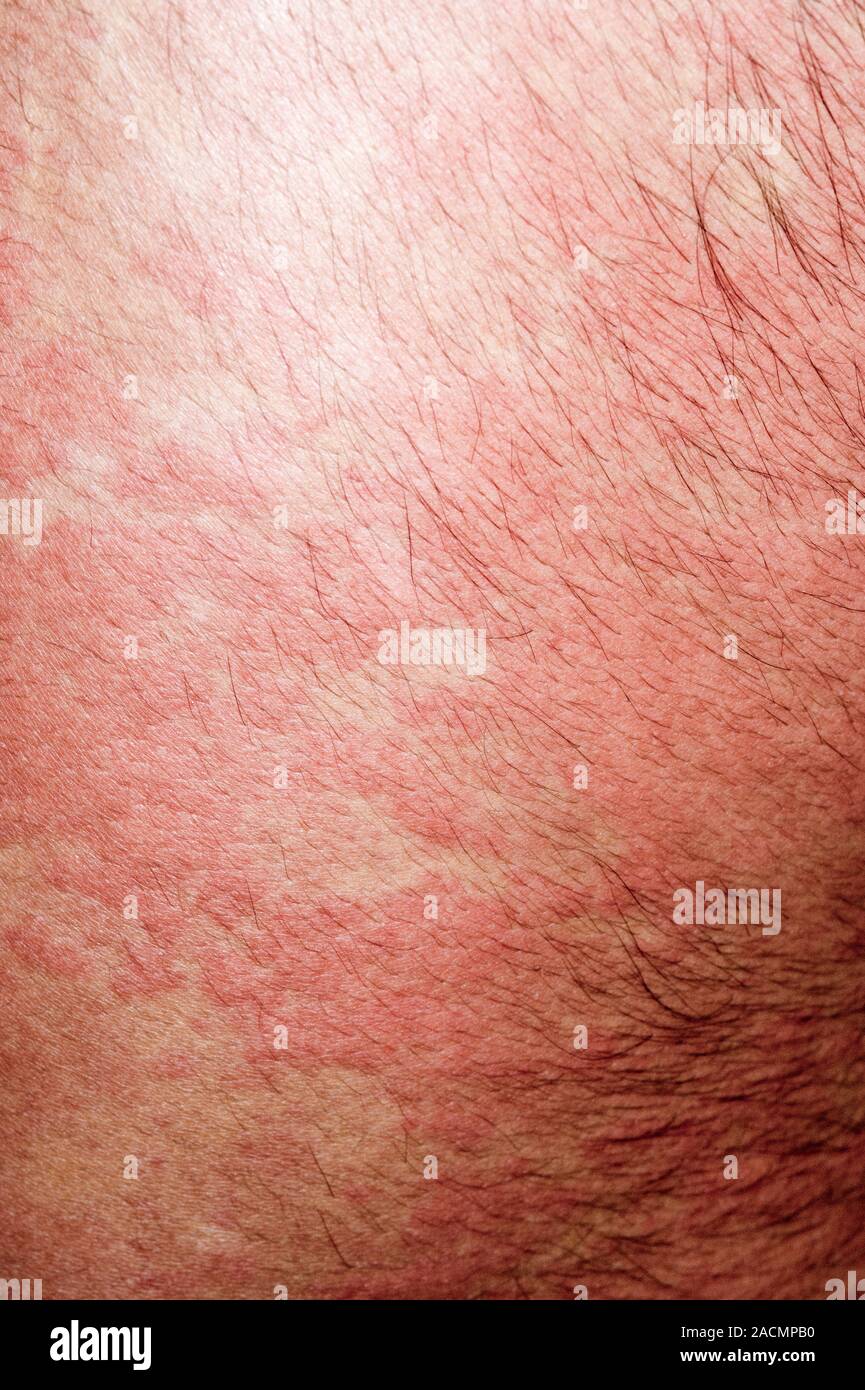 Red rash (hives or nettle rash) on the skin of the back in a 22 year