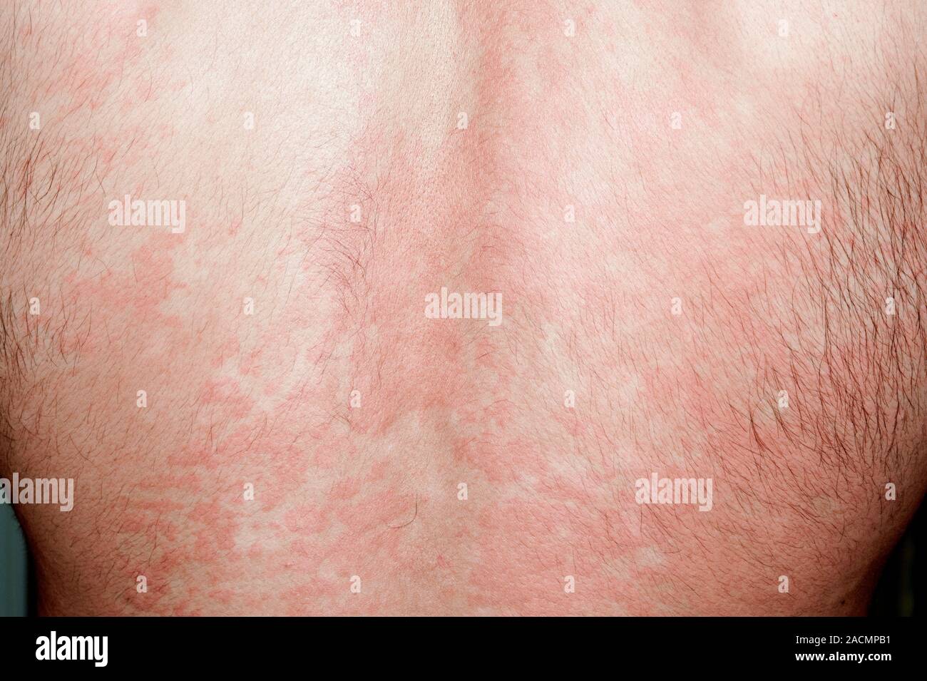 Red rash (hives or nettle rash) on the skin of the back in a 22 year