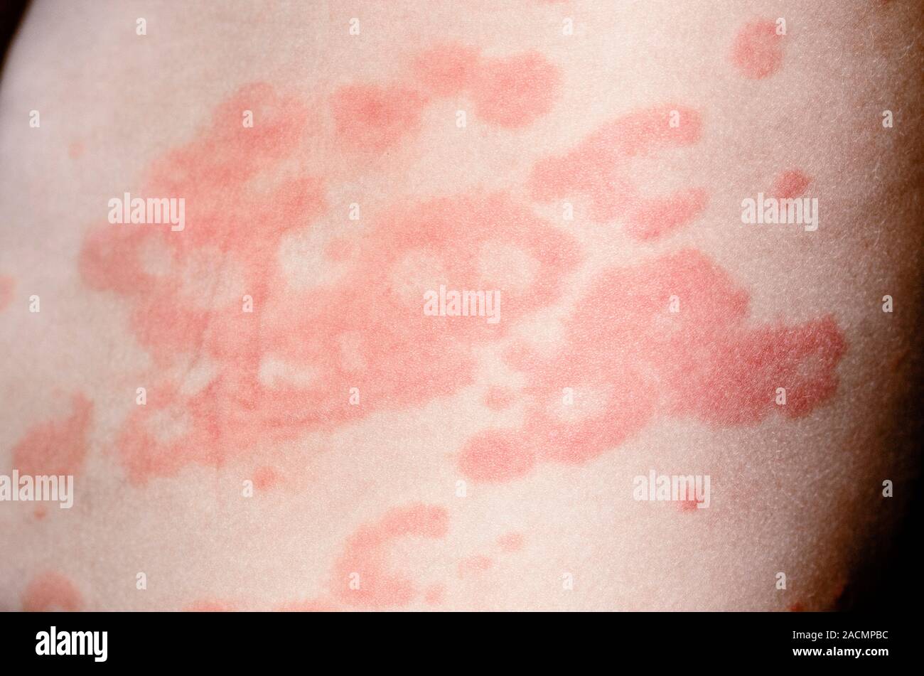 Red rash (hives or nettle rash) on the skin in a 2 year old male patient caused by urticaria, a rash of itchy wheals that in this case was secondary t Stock Photo