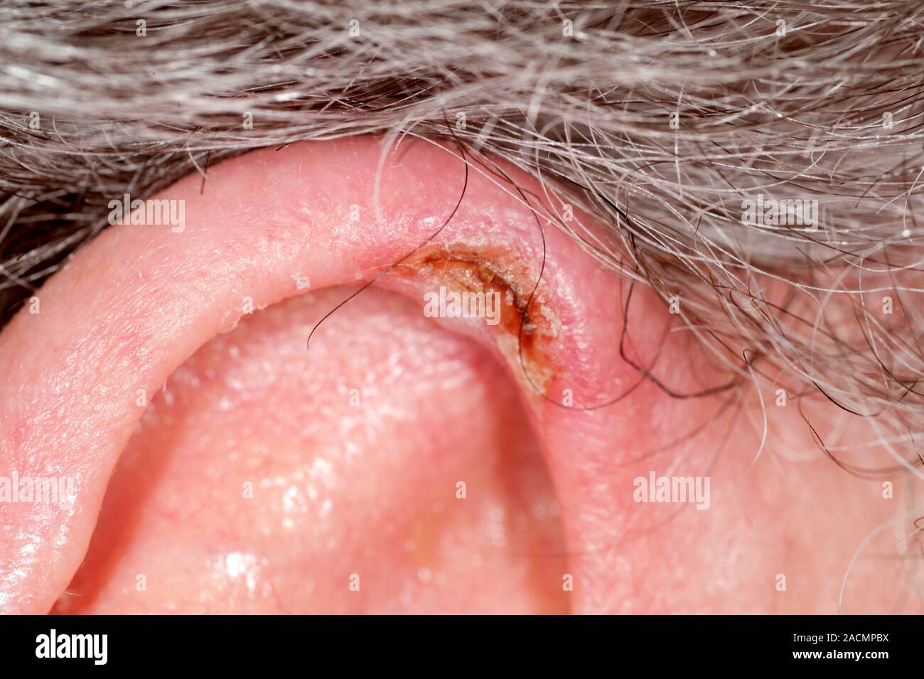 Closeup of a red and scabbed nodule on the ear pinna in a 67 year old